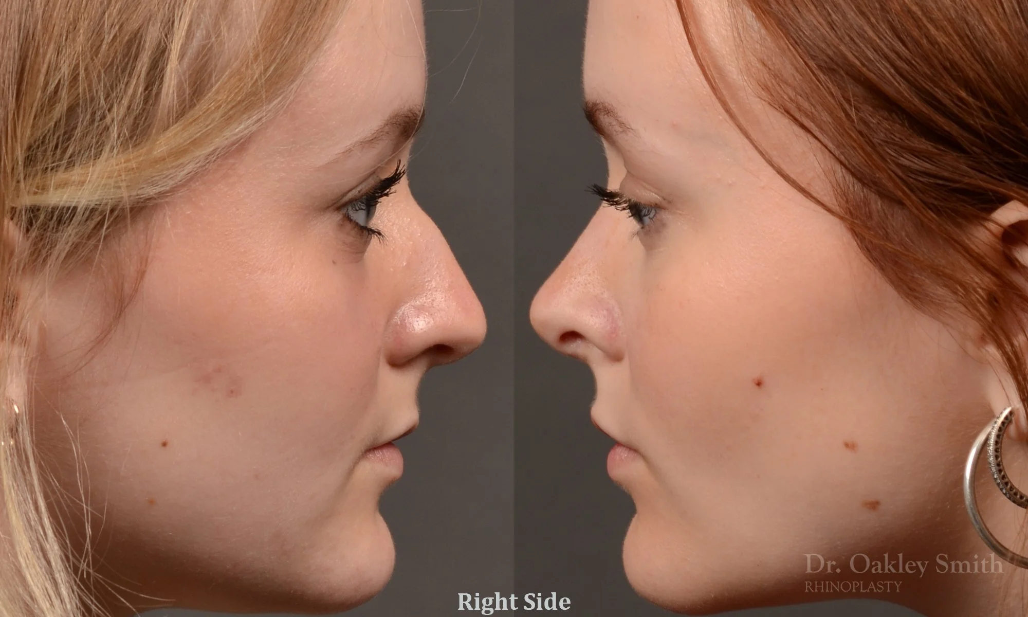 475: Female, Primary  Rhinoplasty, Normal Skin, Bridge Work, Tip Work