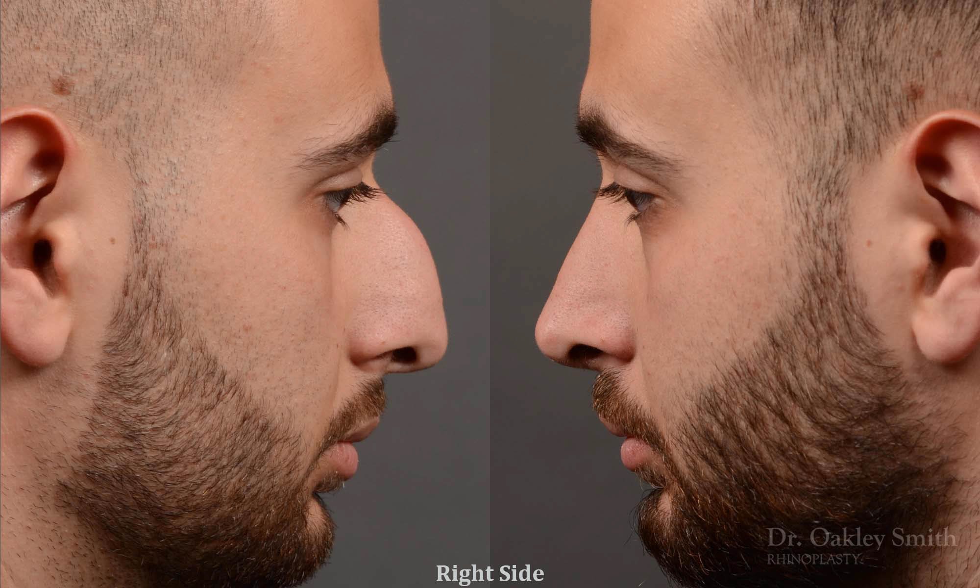 491: Primary Male Rhinoplasty, Normal Skin, Bridge Work, Tip Work