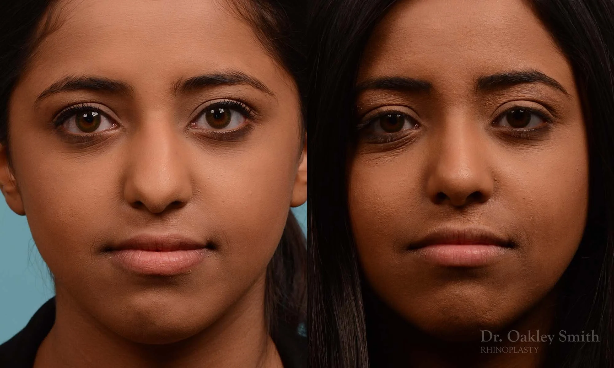 285A-rhinoplasty-dr-oakley-smith-toronto-nose-job.jpg