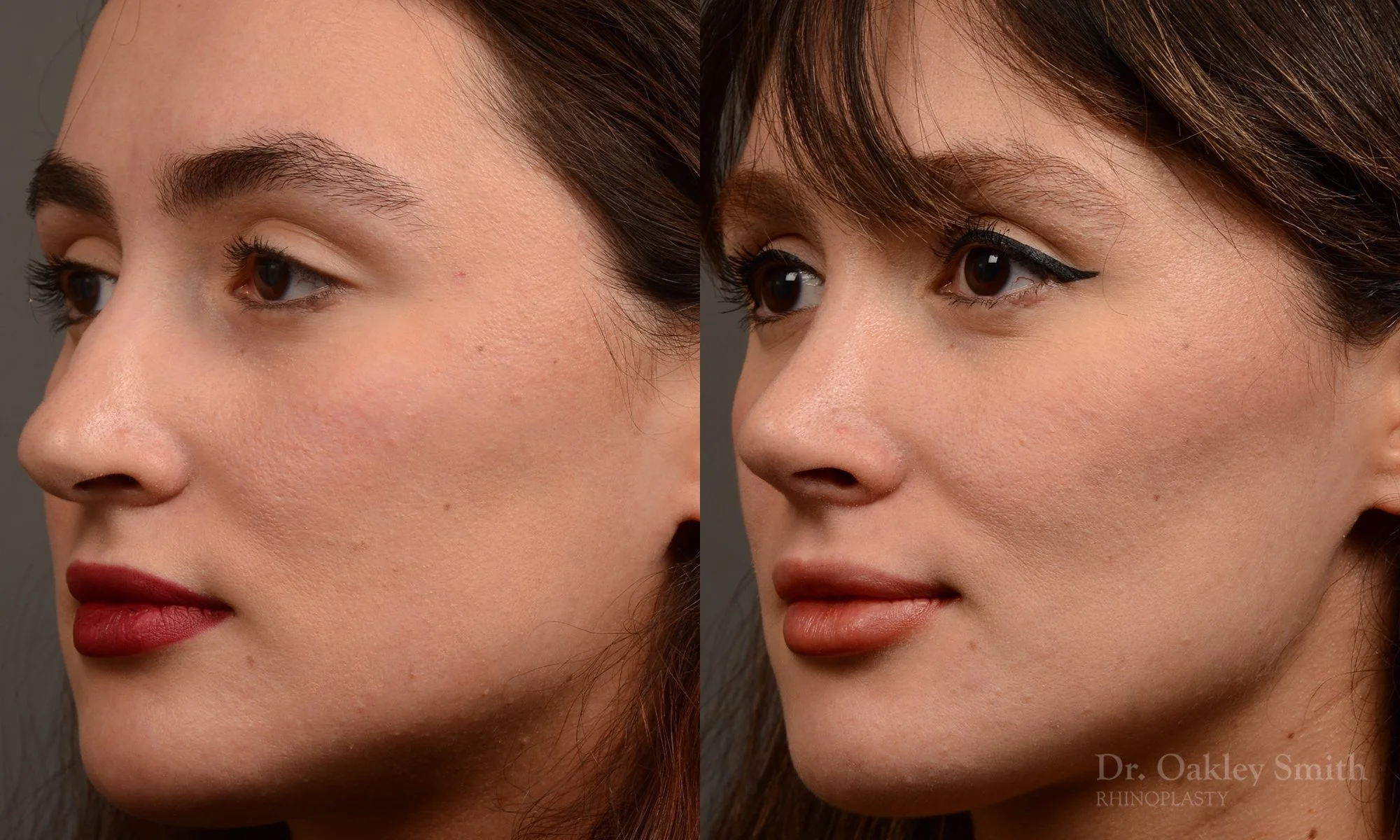 526D-rhinoplasty-dr-oakley-smith-toronto-top-surgeon-nose-job.jpg