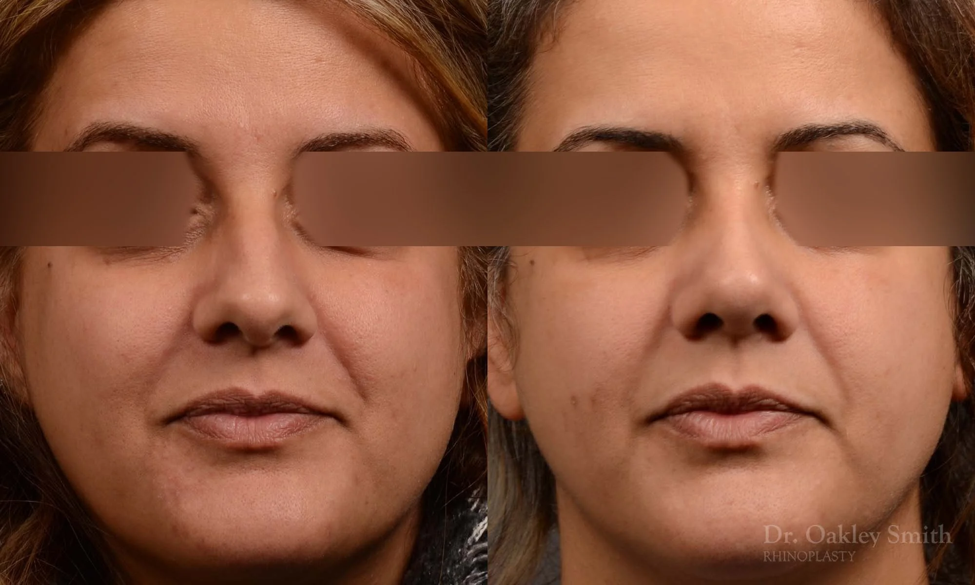 527A-rhinoplasty-dr-oakley-smith-toronto-top-surgeon-nose-job.jpg
