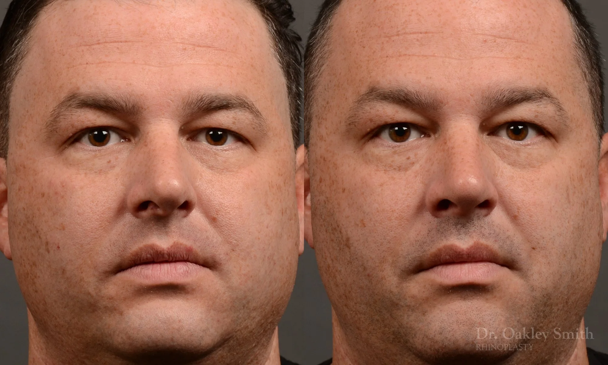514A-male-rhinoplasty-dr-oakley-smith-toronto-nose-job.jpg