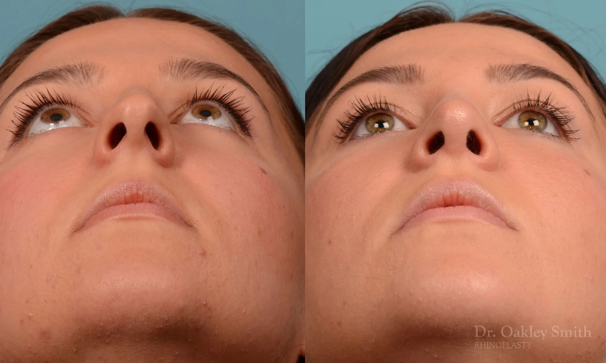 209F-nose-job-curved-nose-straight-profile-deviated-septum-rhinoplasty-septoplasty-dr-oakley-smith-toronto-1.jpg