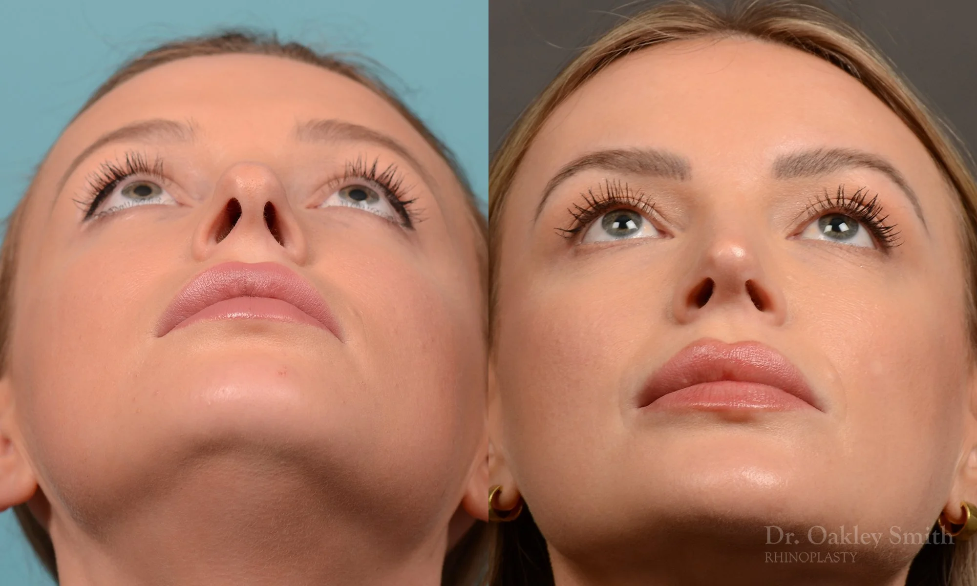 538F-rhinoplasty-dr-oakley-smith-toronto-nose-job.jpg