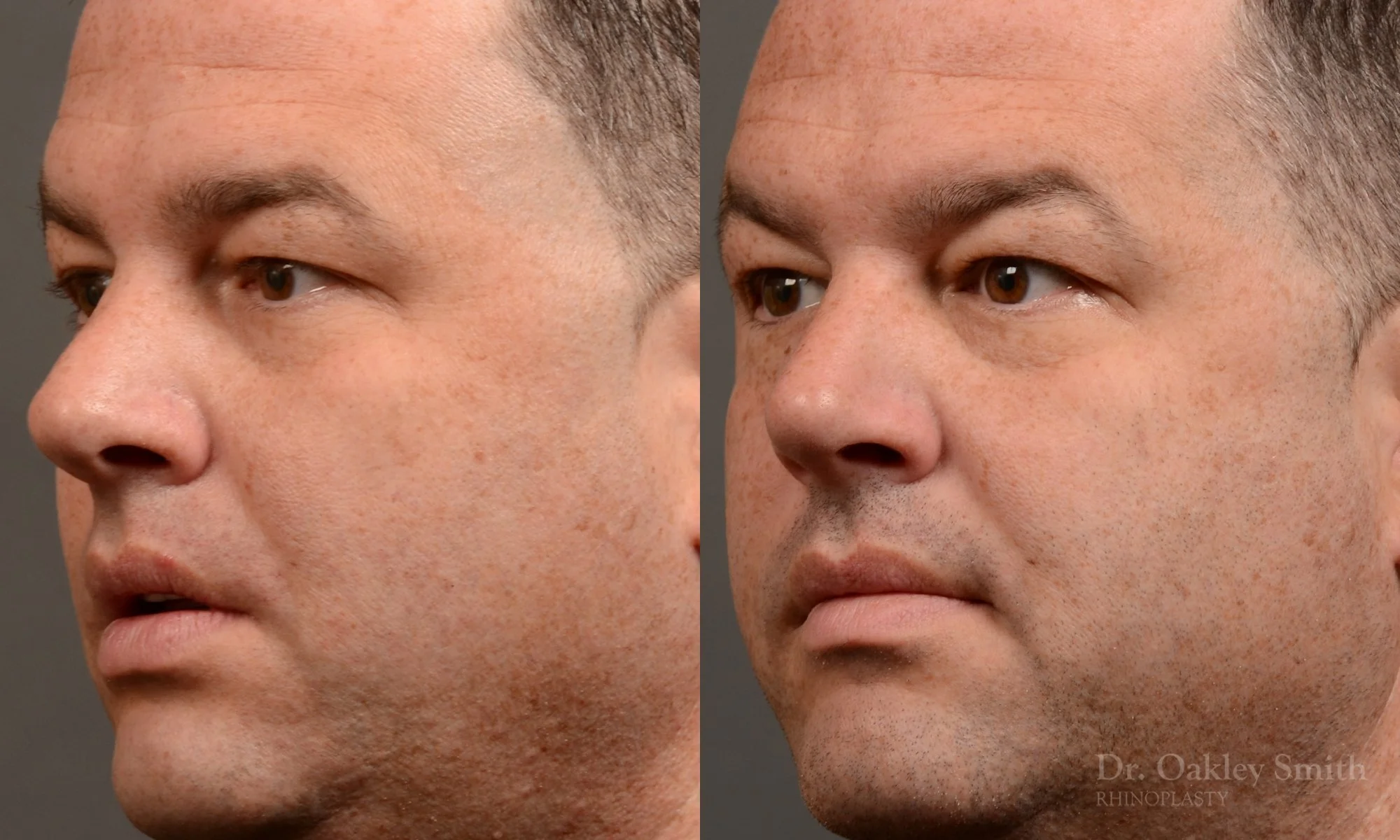 514D-male-rhinoplasty-dr-oakley-smith-toronto-nose-job.jpg