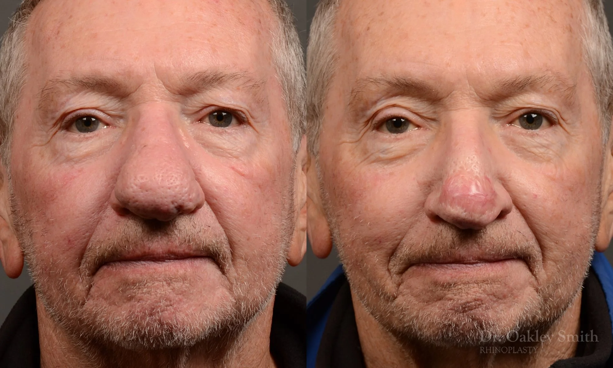 548: Rhinophyma Male