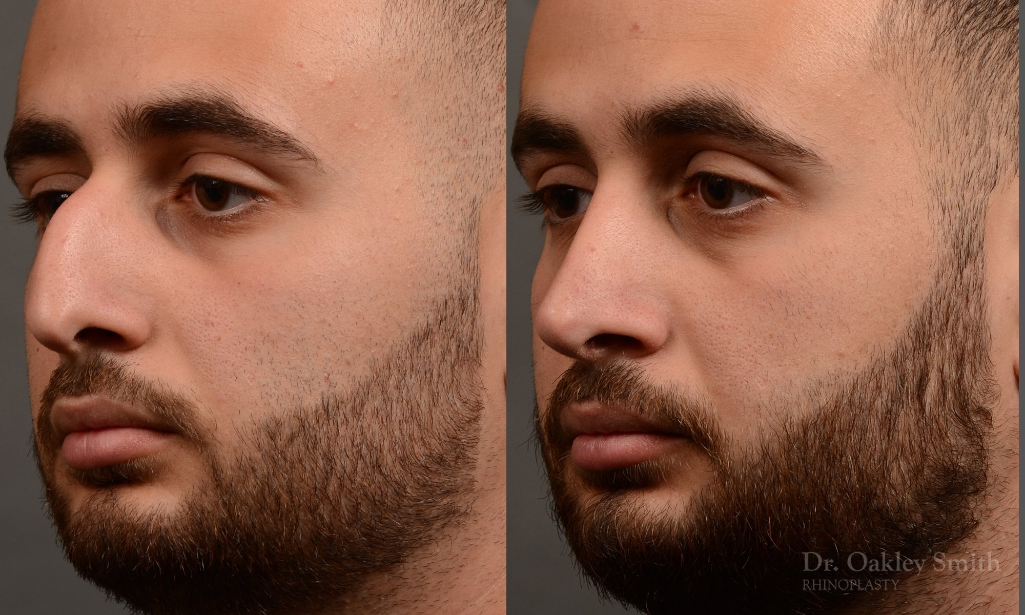 391D-rhinoplasty-dr-oakley-smith-toronto-nose-job.jpg