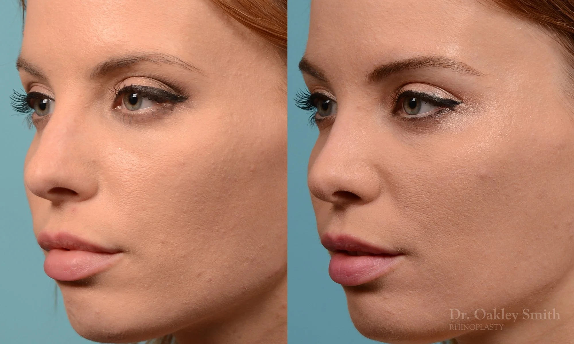 231D-rhinoplasty-dr-oakley-smith-toronto-nose-job-long-nose-bump-bridge-2.jpg
