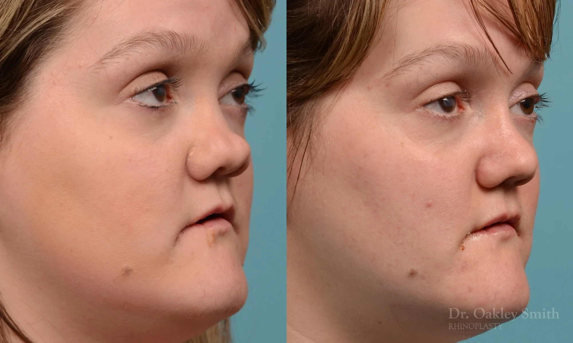 241B-rhinioplasty-nose-job-dr-oakley-smith-toronto-1.jpg