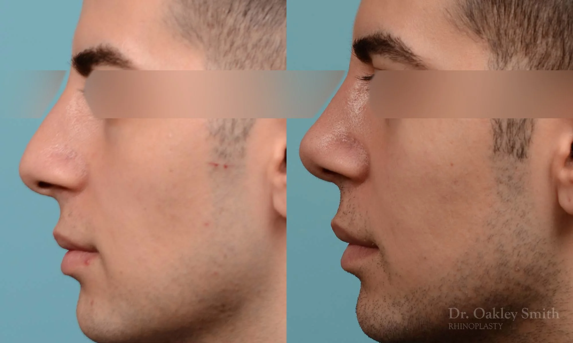 253E-rhinoplasty-dr-oakley-smith-toronto-male-nose-job.jpg