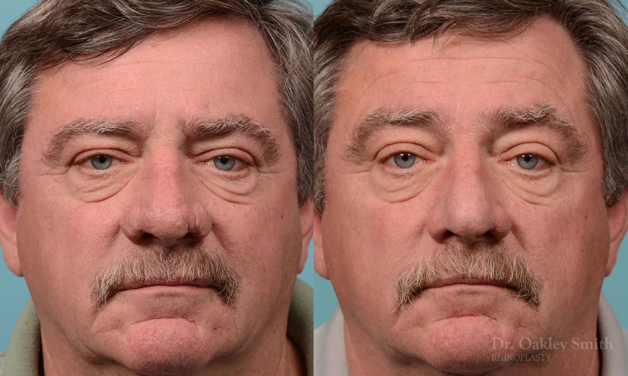 210A-rhinoplasty-rhinophyma-elderly-man-dr-oakley-smith-toronto-nose-reduction-1.jpg