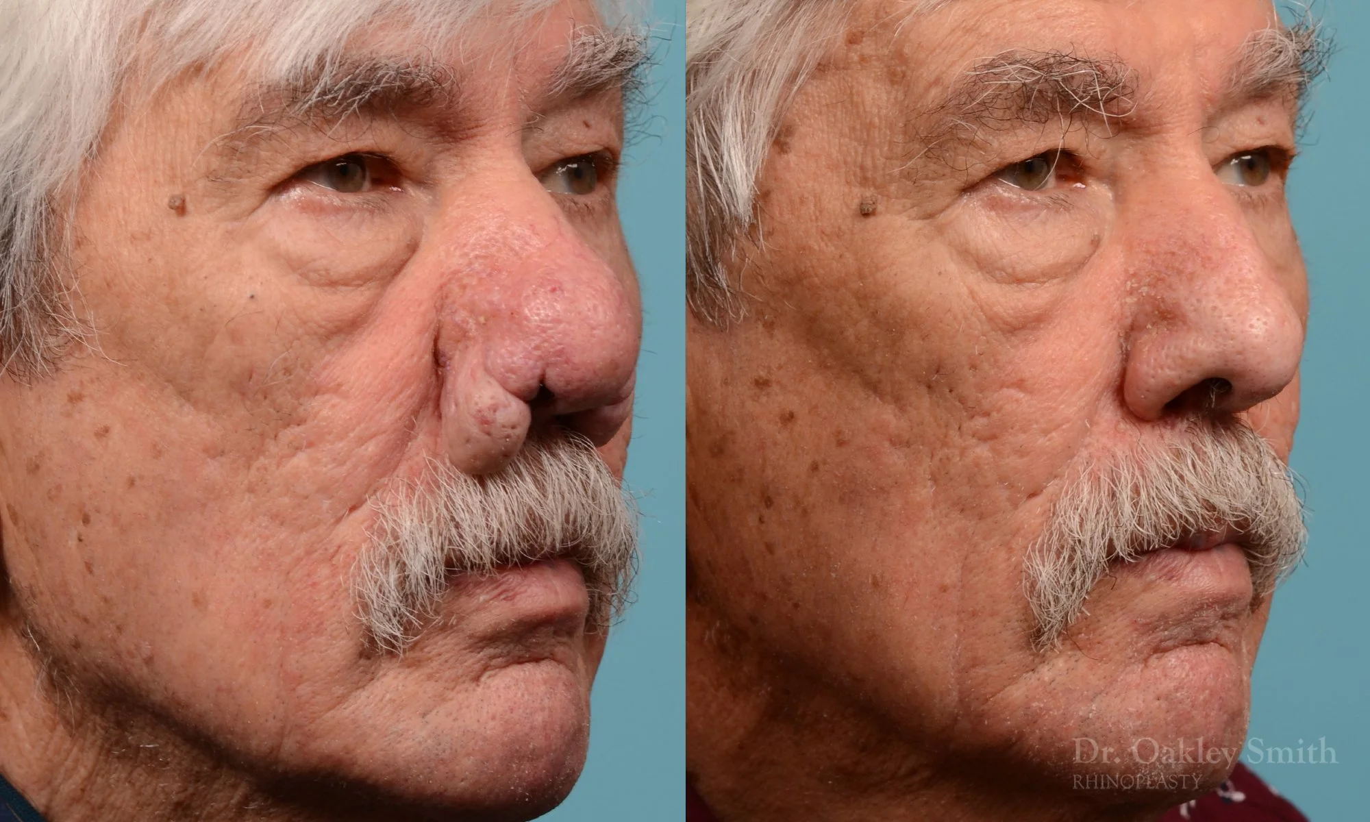 227B-rhinophyma-rhinoplasty-dr-oakley-smith-toronto-nose-job-1.jpg