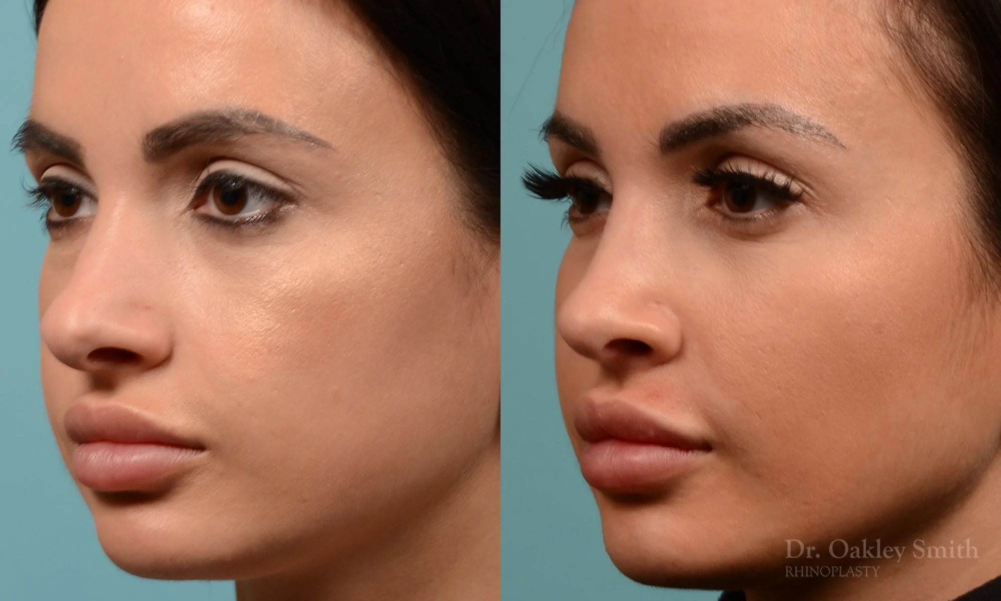259D-rhinoplasty-dr-oakley-smith-toronto-nose-job.jpg