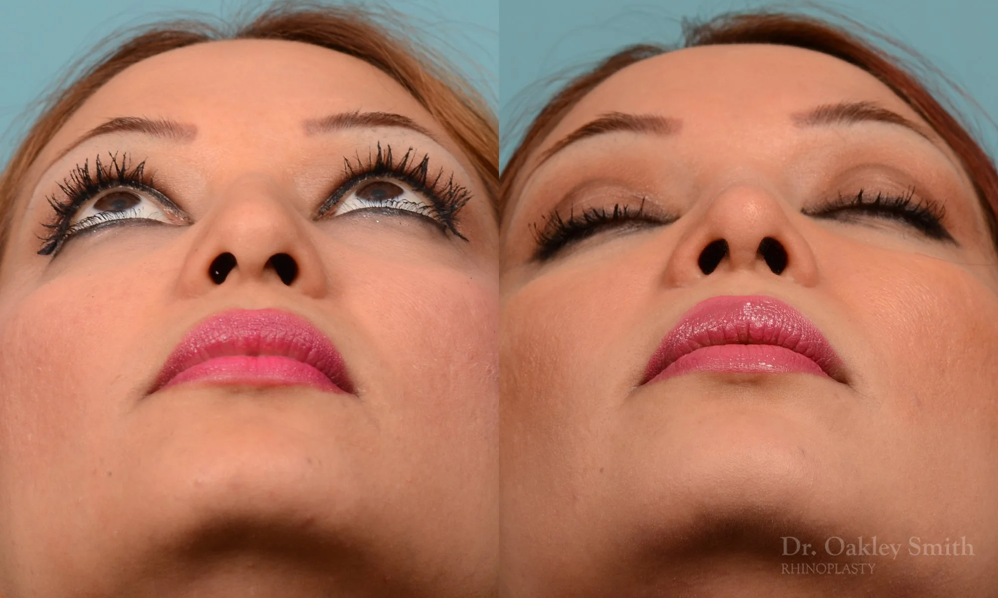260F-rhinoplasty-dr-oakley-smith-toronto-nose-job.jpg