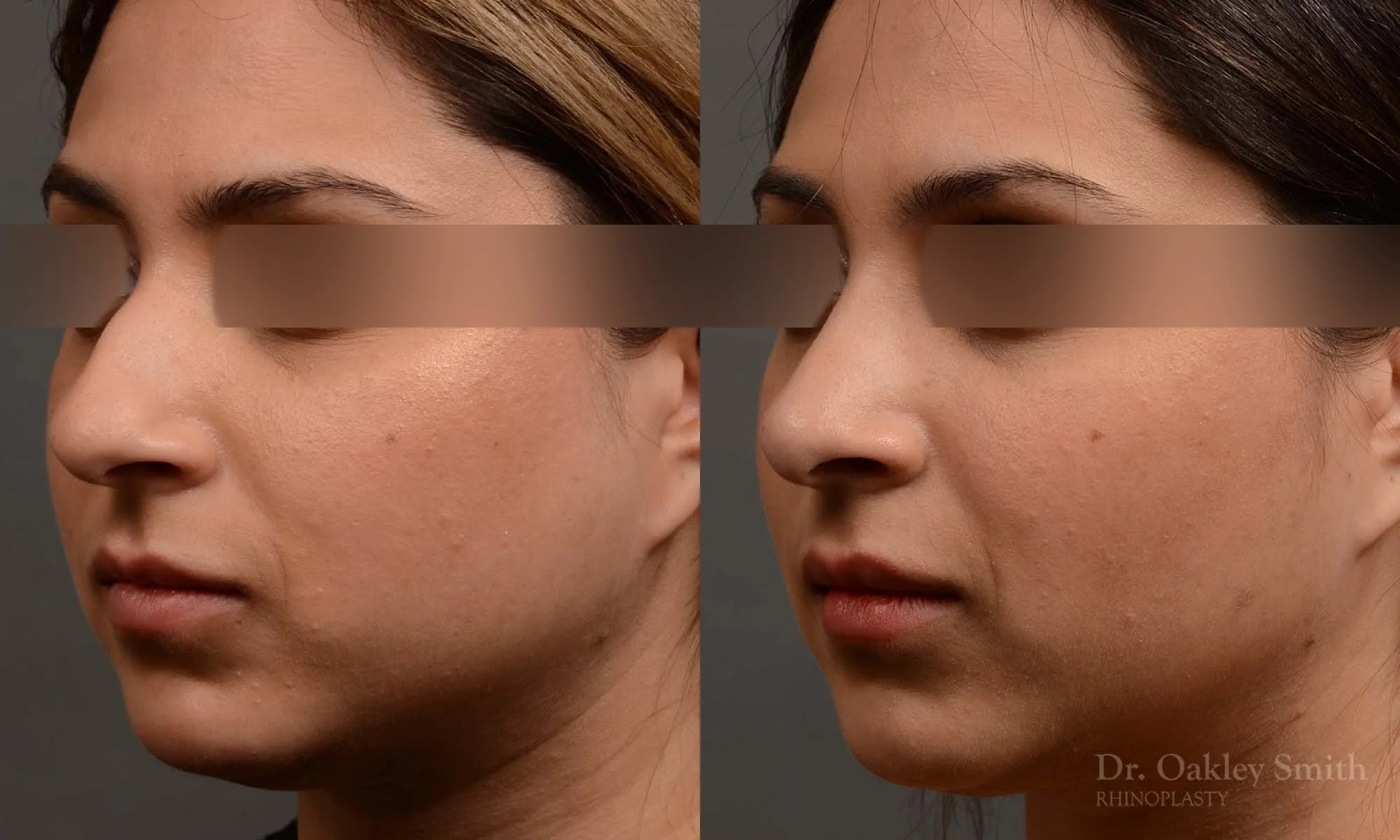 333D-rhinoplasty-dr-oakley-smith-toronto-nose-job.jpg