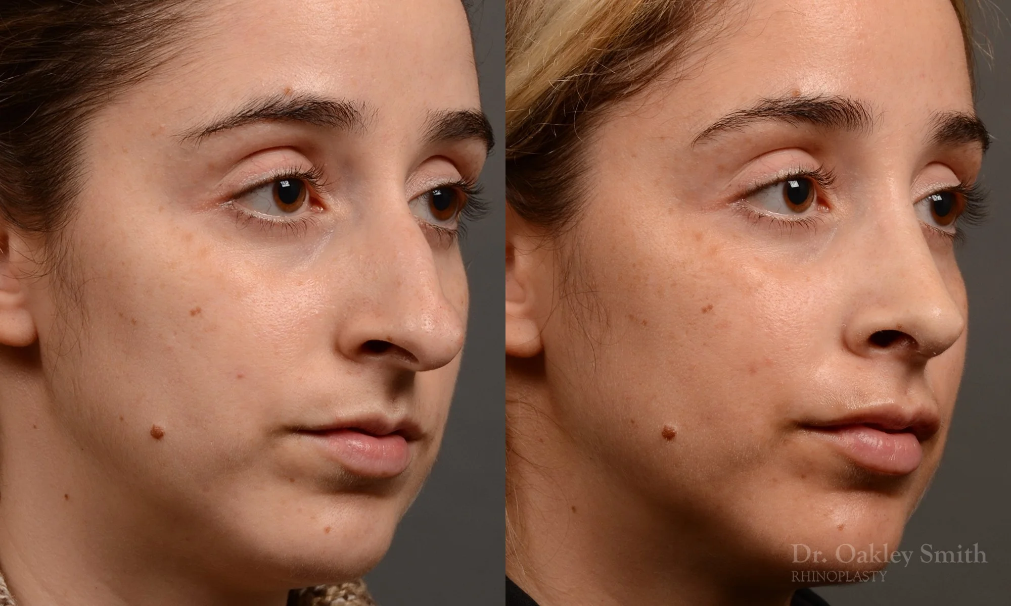 286B-rhinoplasty-dr-oakley-smith-toronto-nose-job.jpg