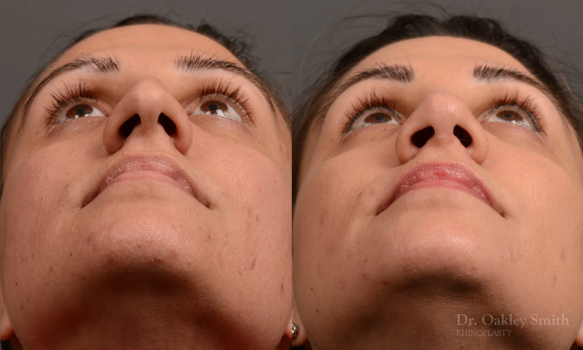 351F-rhinoplasty-dr-oakley-smith-toronto-nose-job.jpg