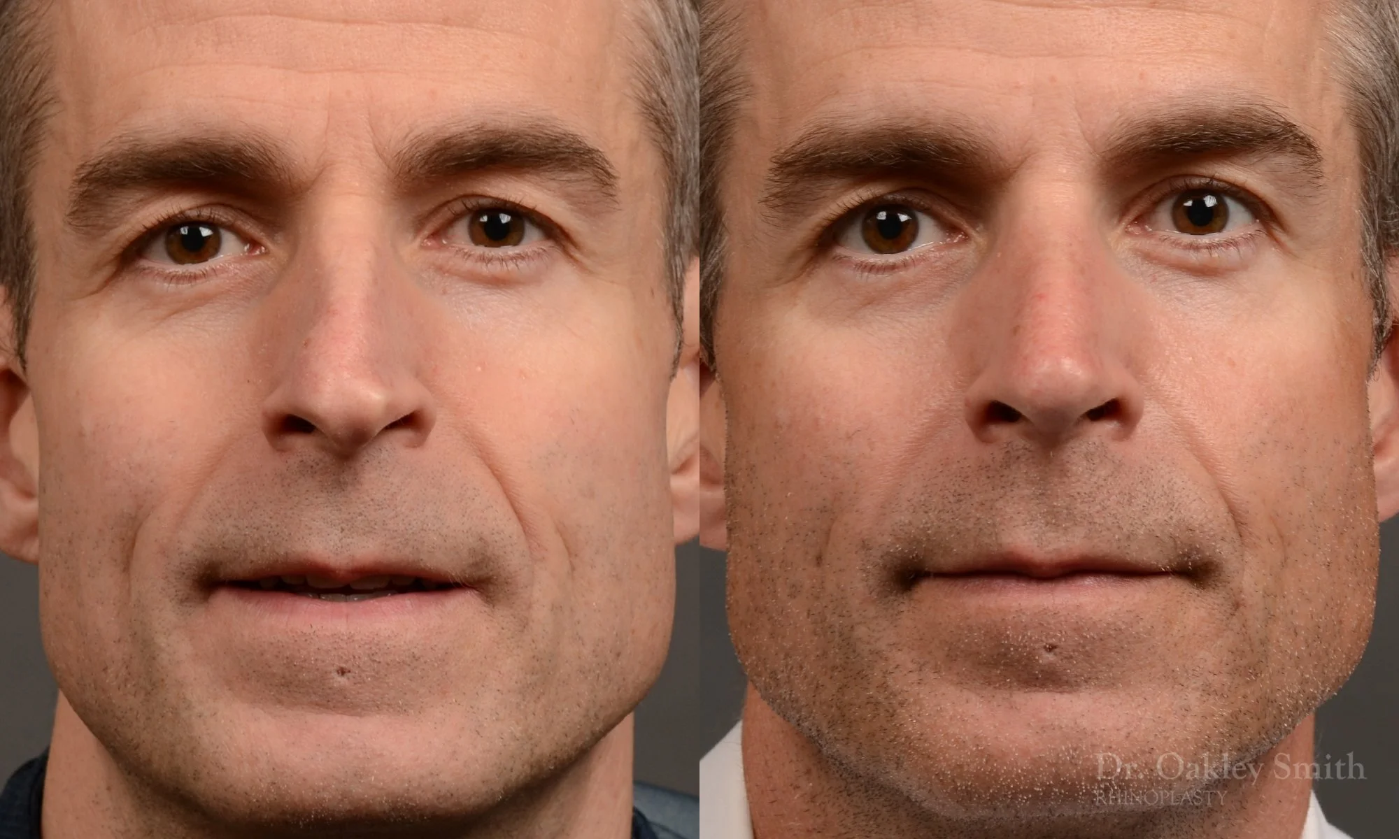 535A-male-rhinoplasty-dr-oakley-smith-toronto-top-surgeon-nose-job.jpg