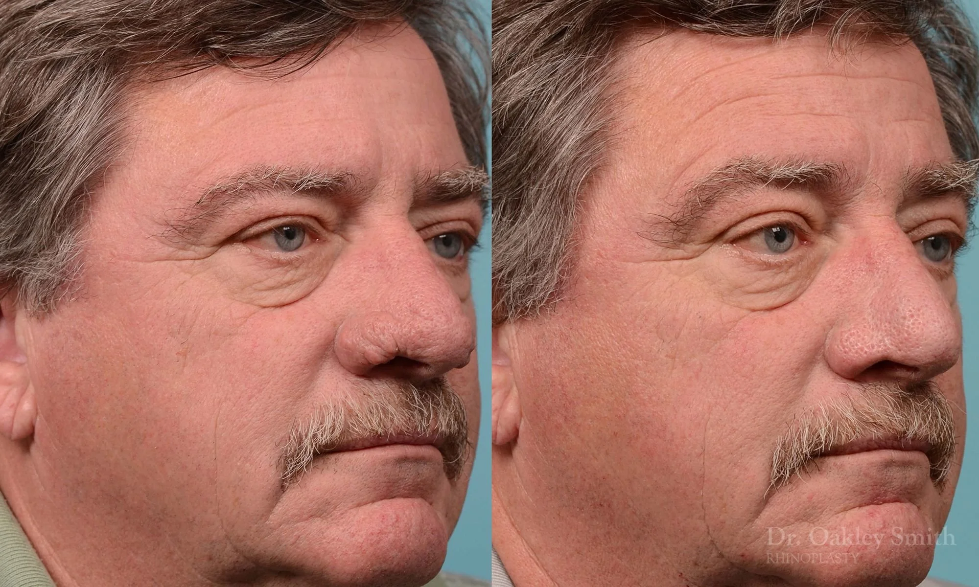 210B-rhinoplasty-rhinophyma-elderly-man-dr-oakley-smith-toronto-nose-reduction-1.jpg
