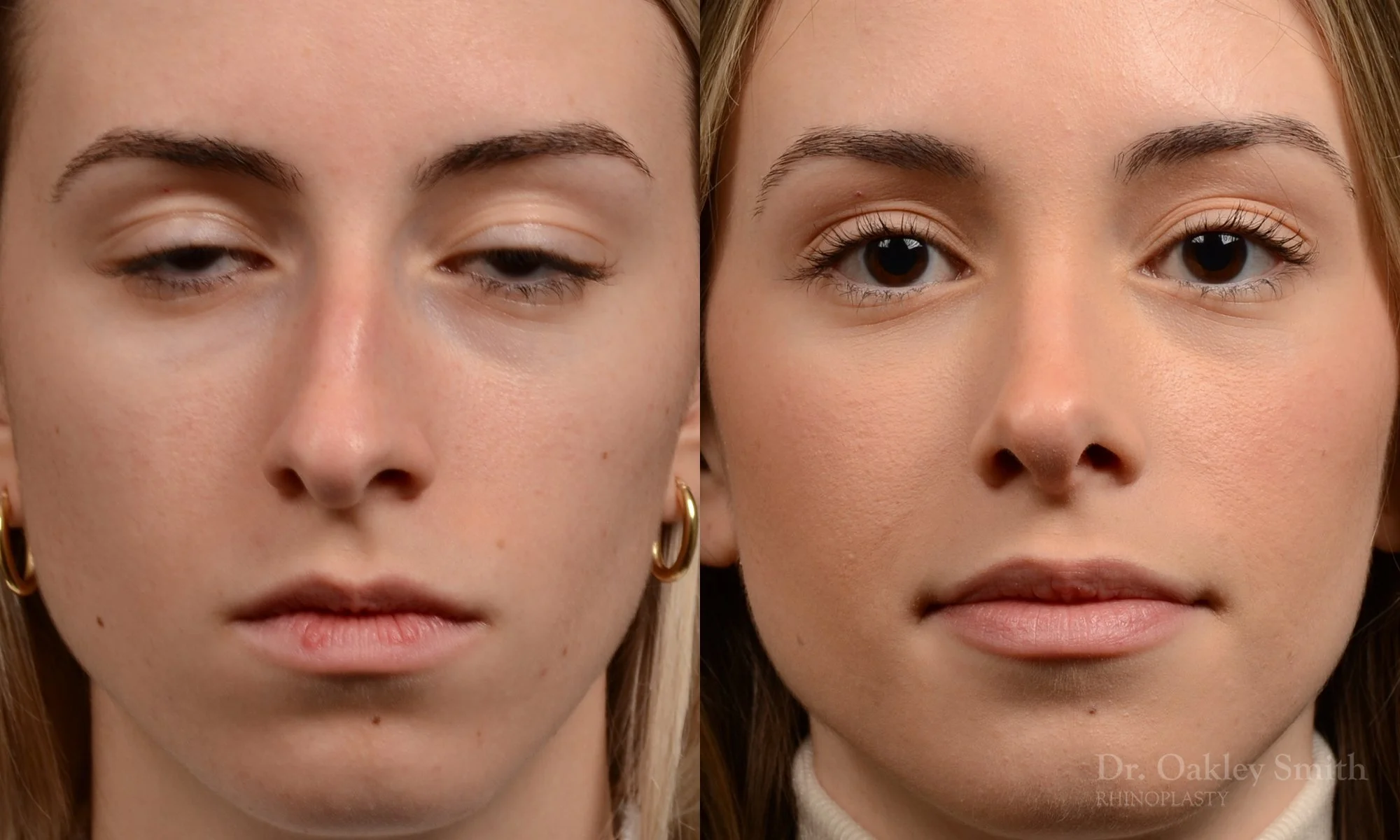 531A-rhinoplasty-dr-oakley-smith-toronto-top-surgeon-nose-job.jpg