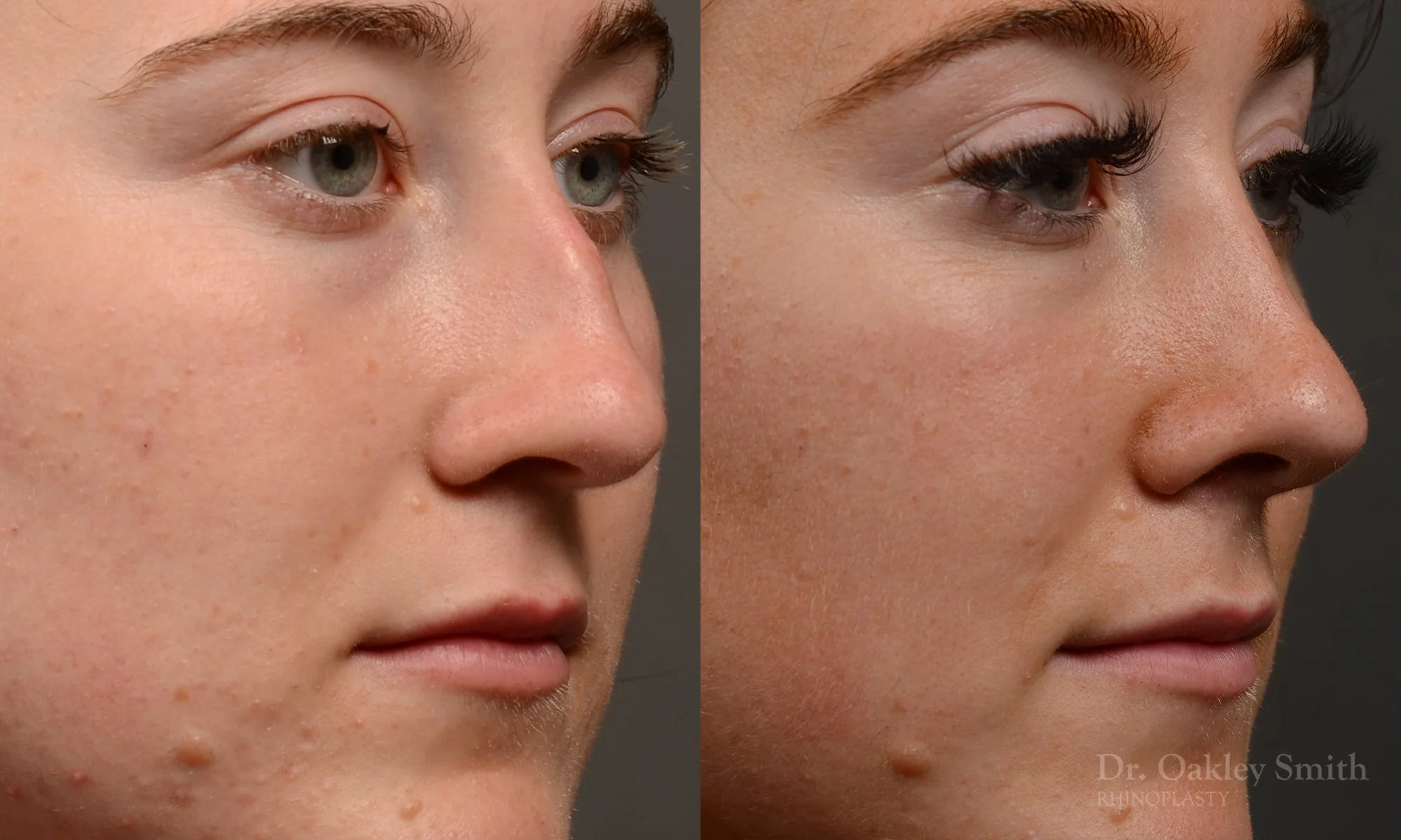 484B-rhinoplasty-dr-oakley-smith-toronto-top-surgeon-nose-job.jpg