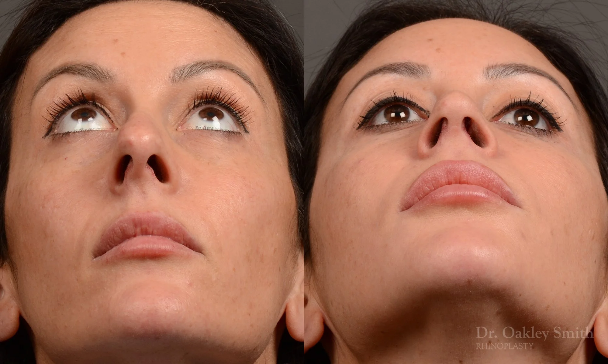 495F-rhinoplasty-dr-oakley-smith-toronto-top-surgeon-nose-job.jpg