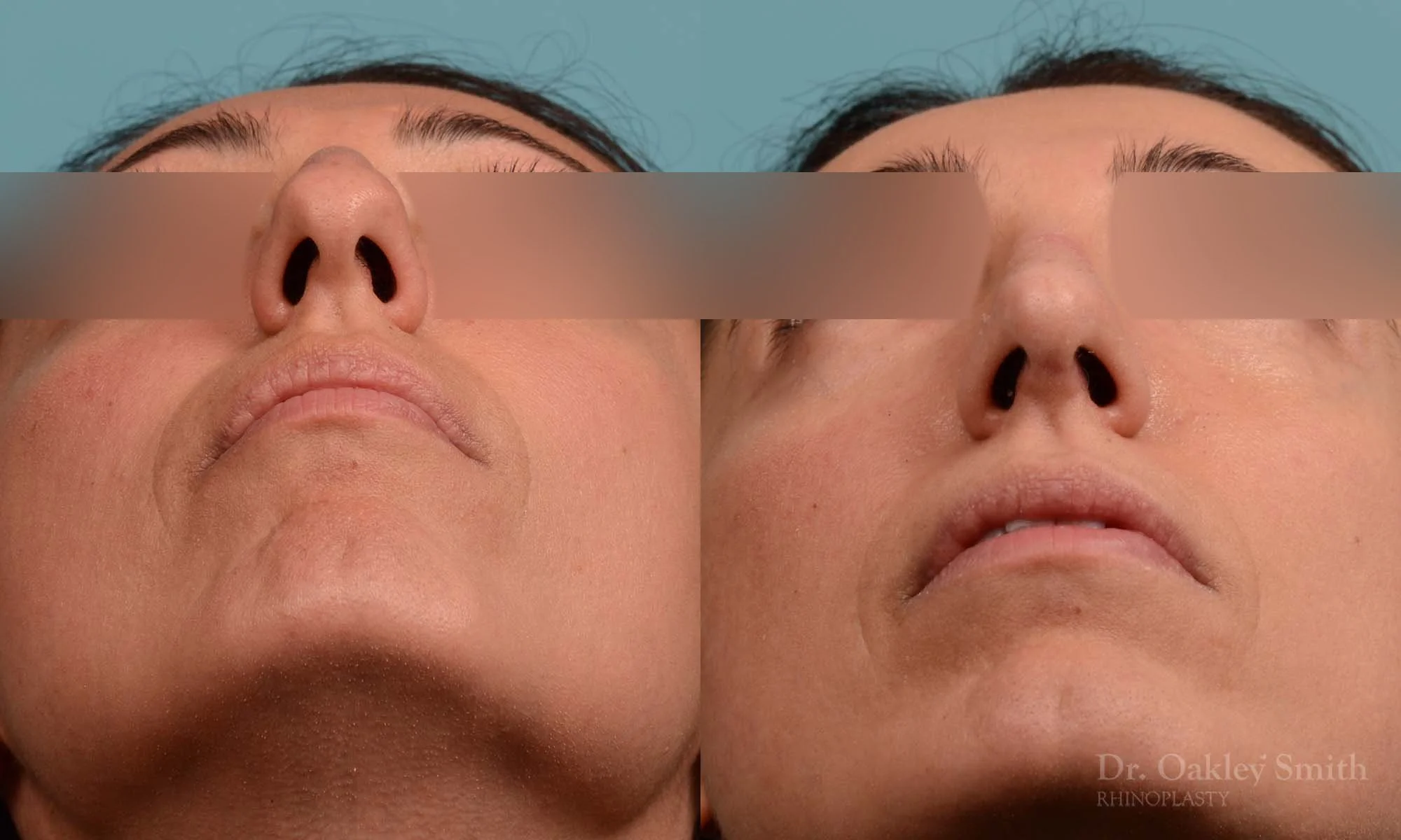273F-rhinoplasty-dr-oakley-smith-toronto-nose-job.jpg