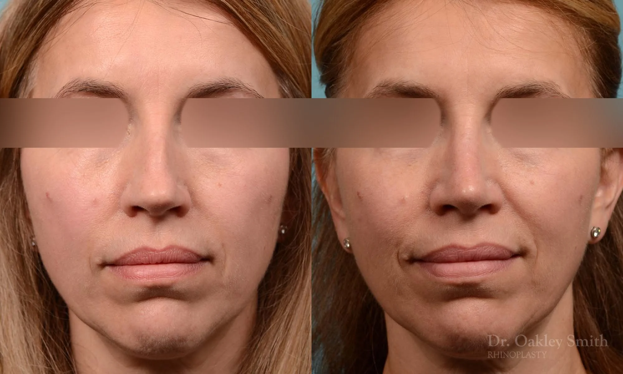 291A-rhinoplasty-dr-oakley-smith-toronto-nose-job.jpg