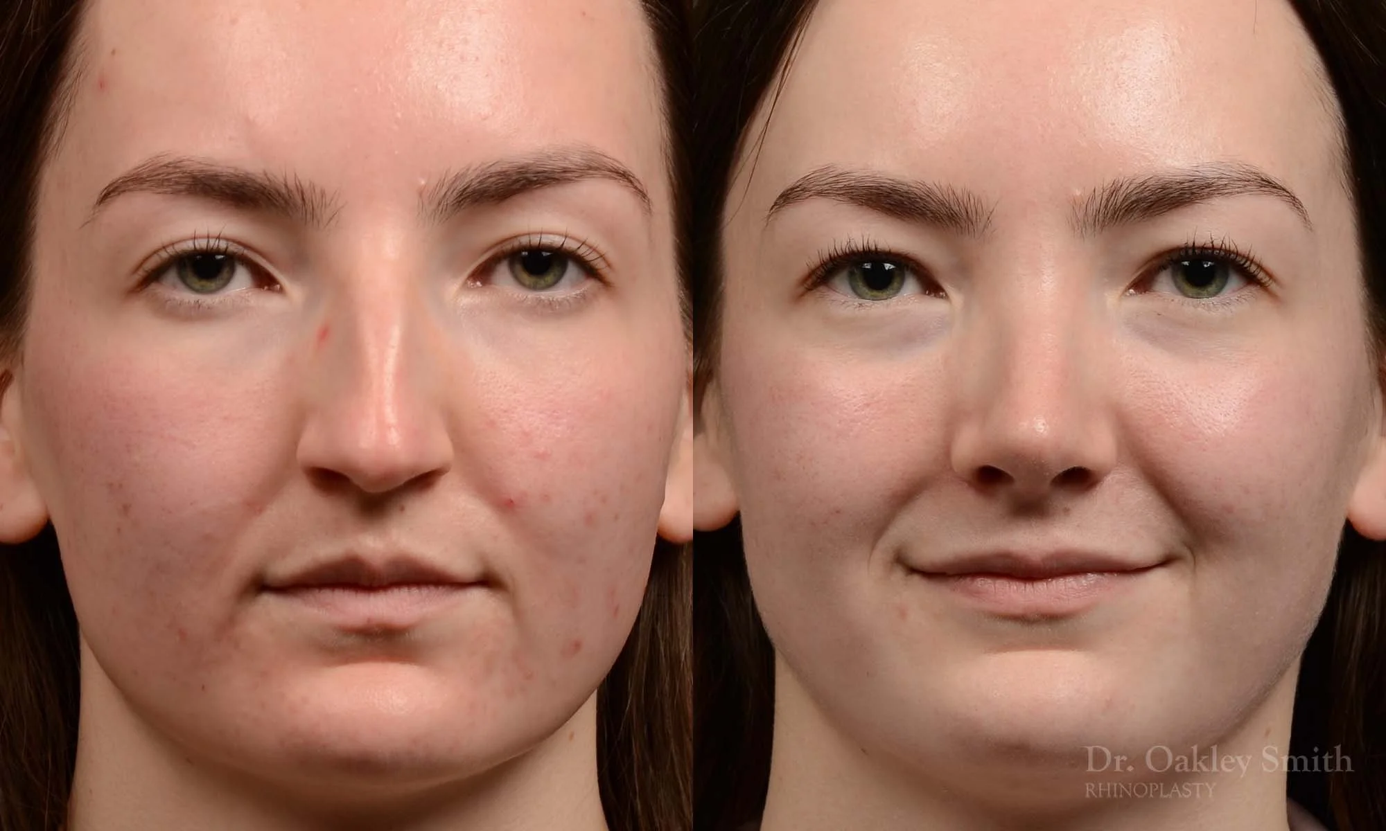 Case 601 Dr. Oakley Smith, preservation rhinoplasty, 12 months after surgery, frontal view