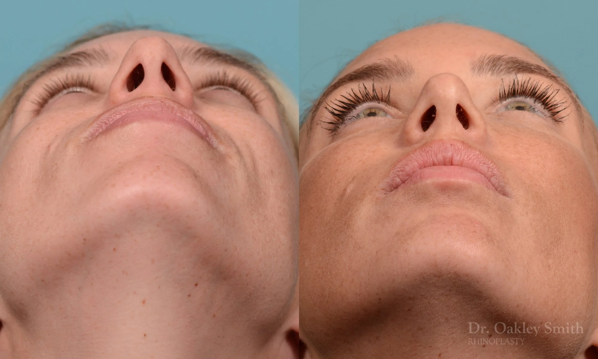284F-rhinoplasty-dr-oakley-smith-toronto-nose-job.jpg