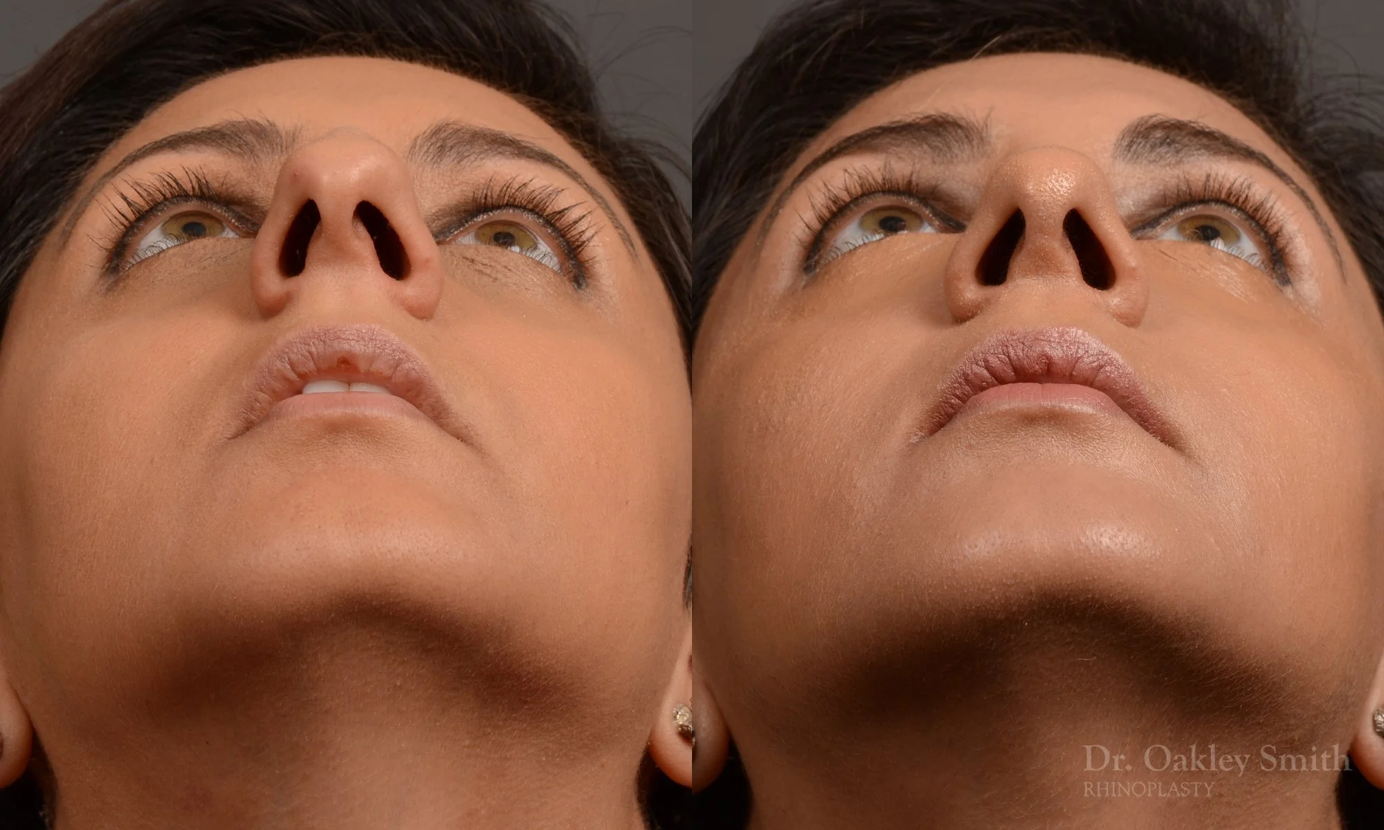 376.1F-rhinoplasty-dr-oakley-smith-toronto-nose-job.jpg