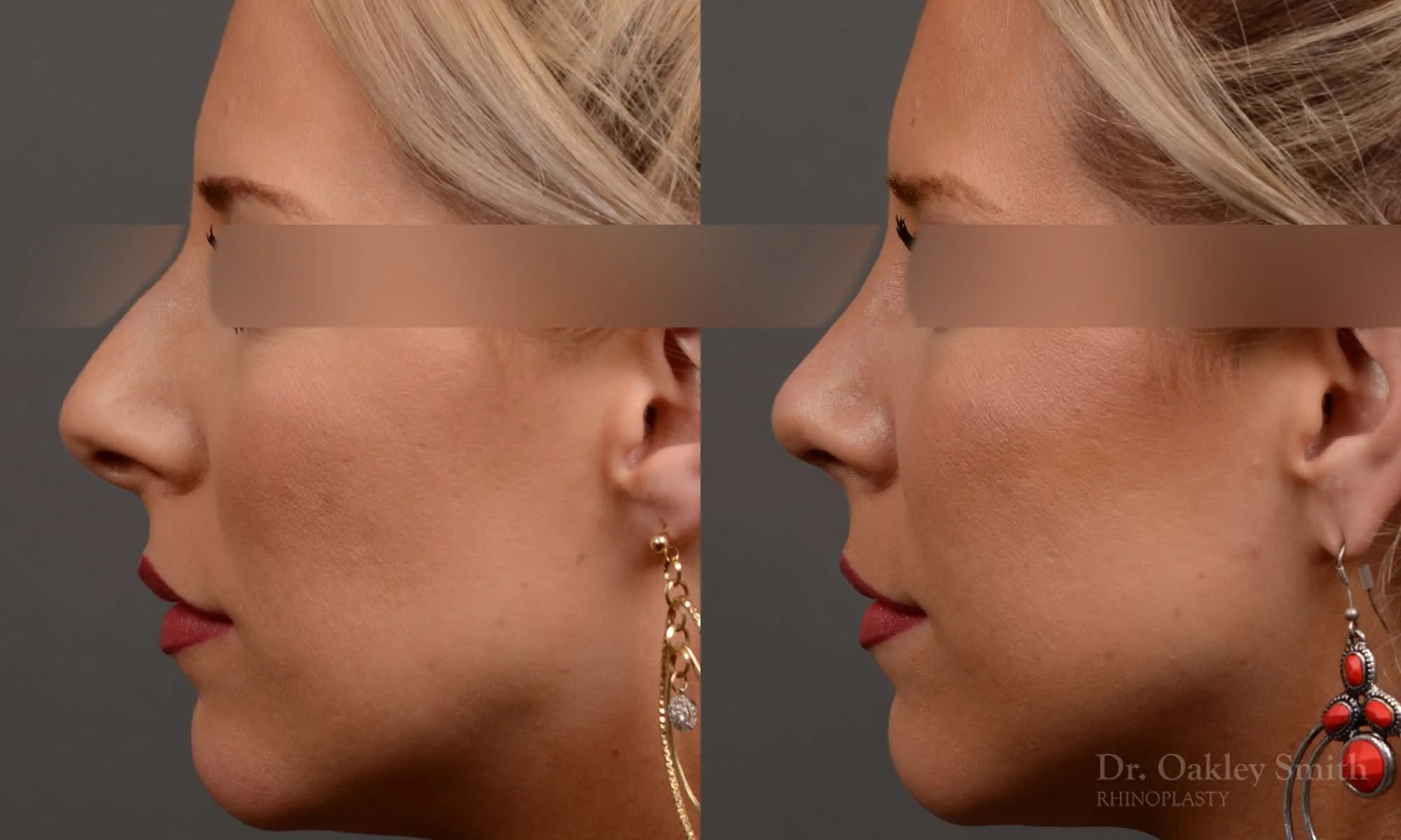 307E-rhinoplasty-dr-oakley-smith-nose-job-toronto.jpg