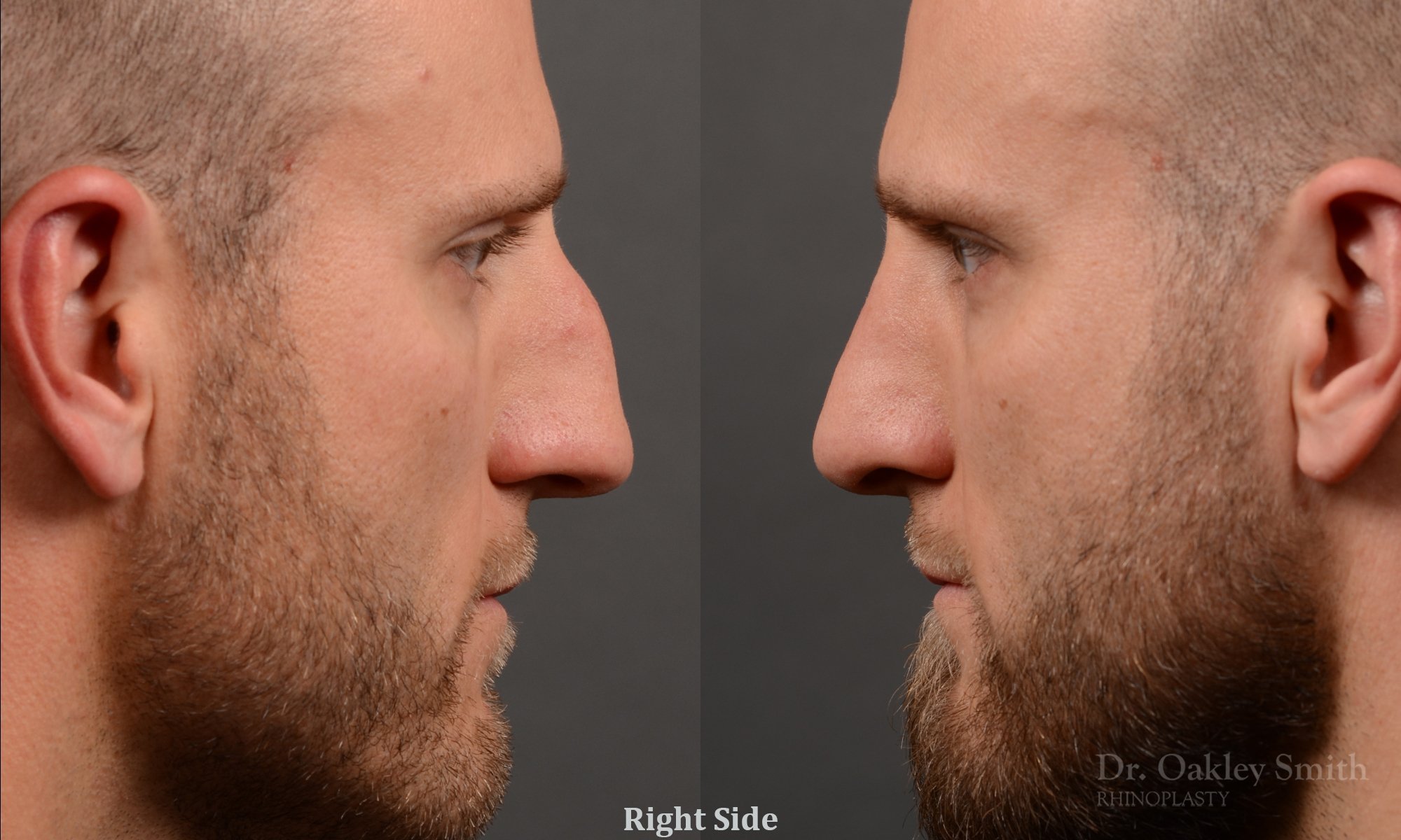 367.1C-rhinoplasty-dr-oakley-smith-toronto-male-nose-job.jpg