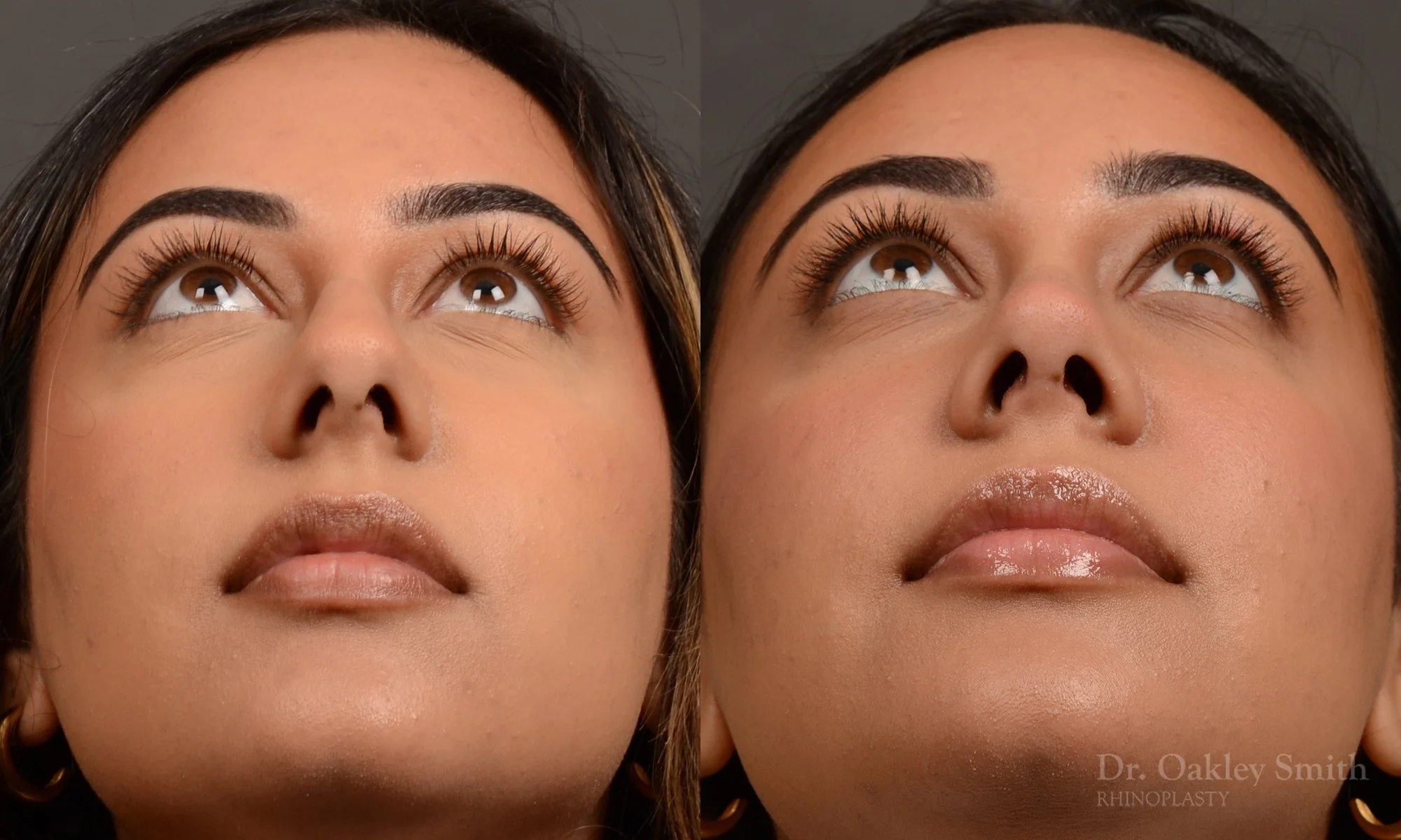 523F-rhinoplasty-dr-oakley-smith-toronto-top-surgeon-nose-job.jpg.jpg