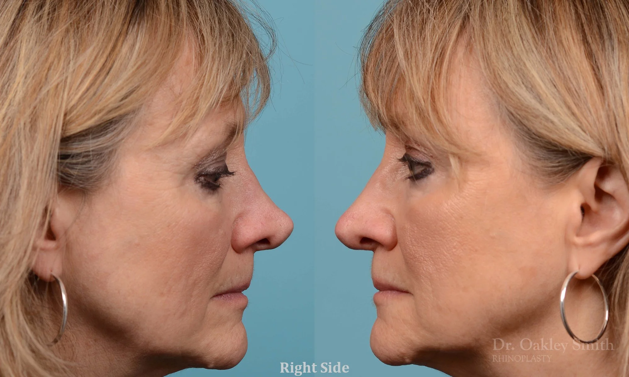 225: Female, Revision Rhinoplasty, Tip Reconstruction Bridge Restoration