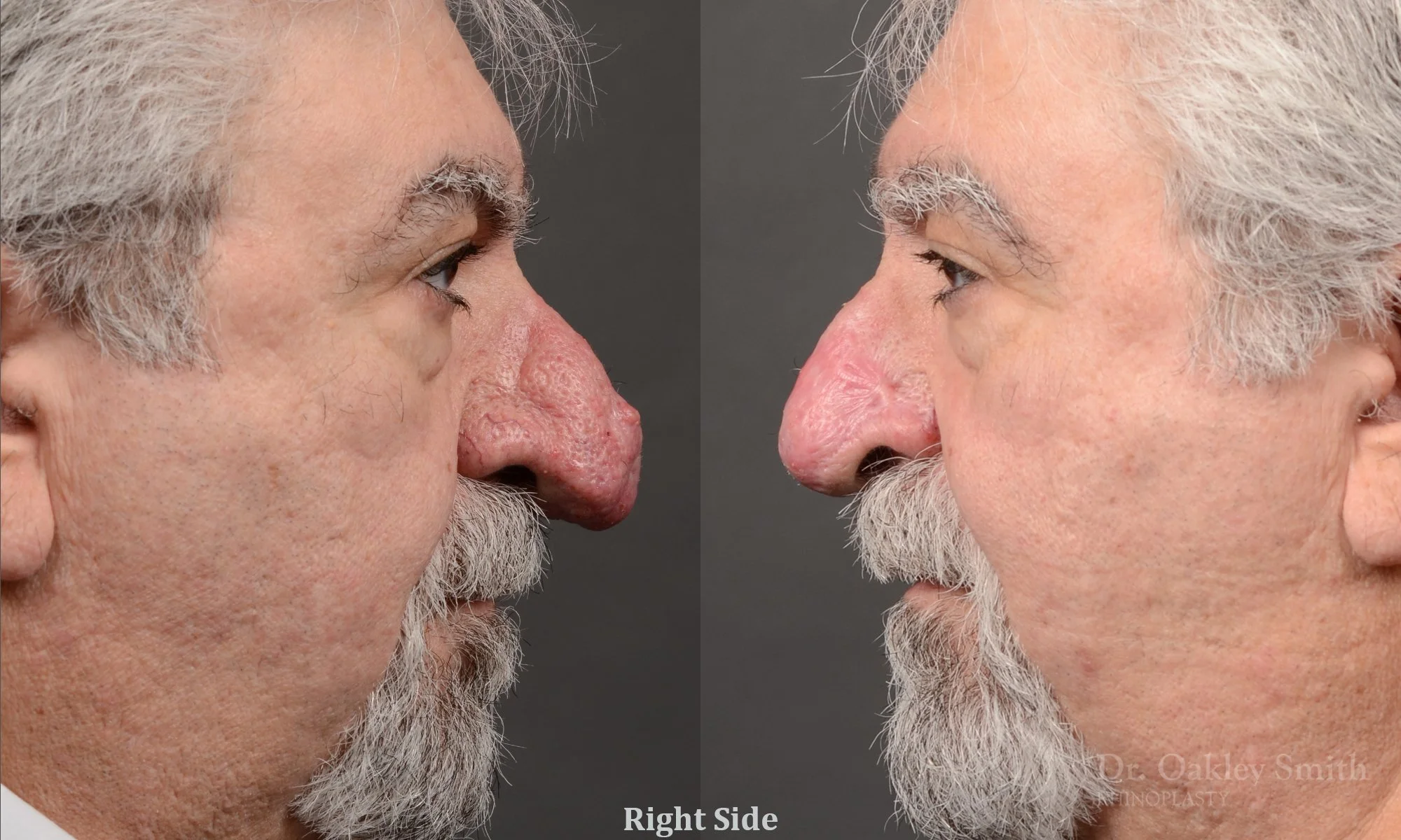 Case 562, Dr. Oakley Smith, rhinophyma rhinoplasty, 12 months after surgery, right profile view