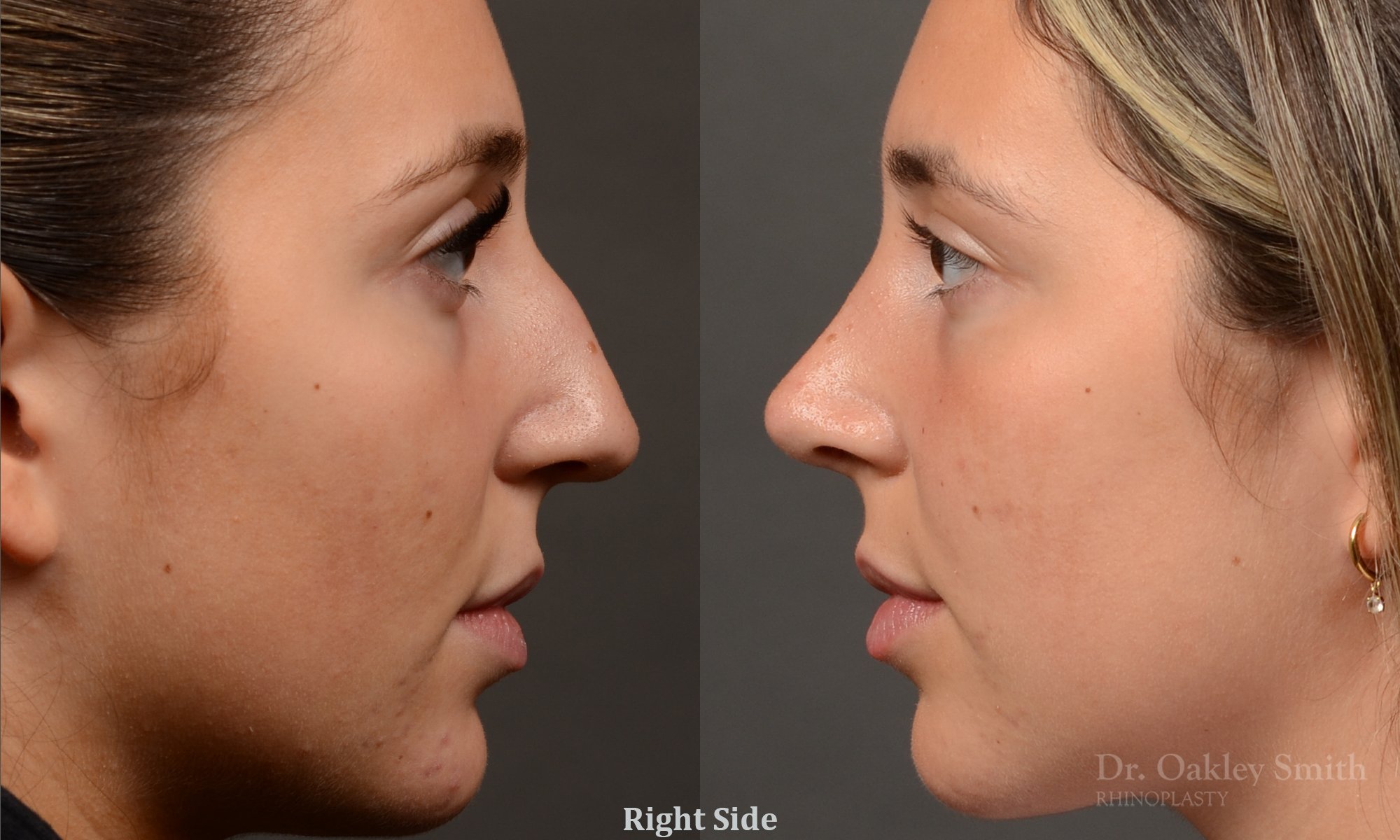 Case 563, Dr. Oakley Smith, preservation rhinoplasty, 12 months after surgery, right profile view