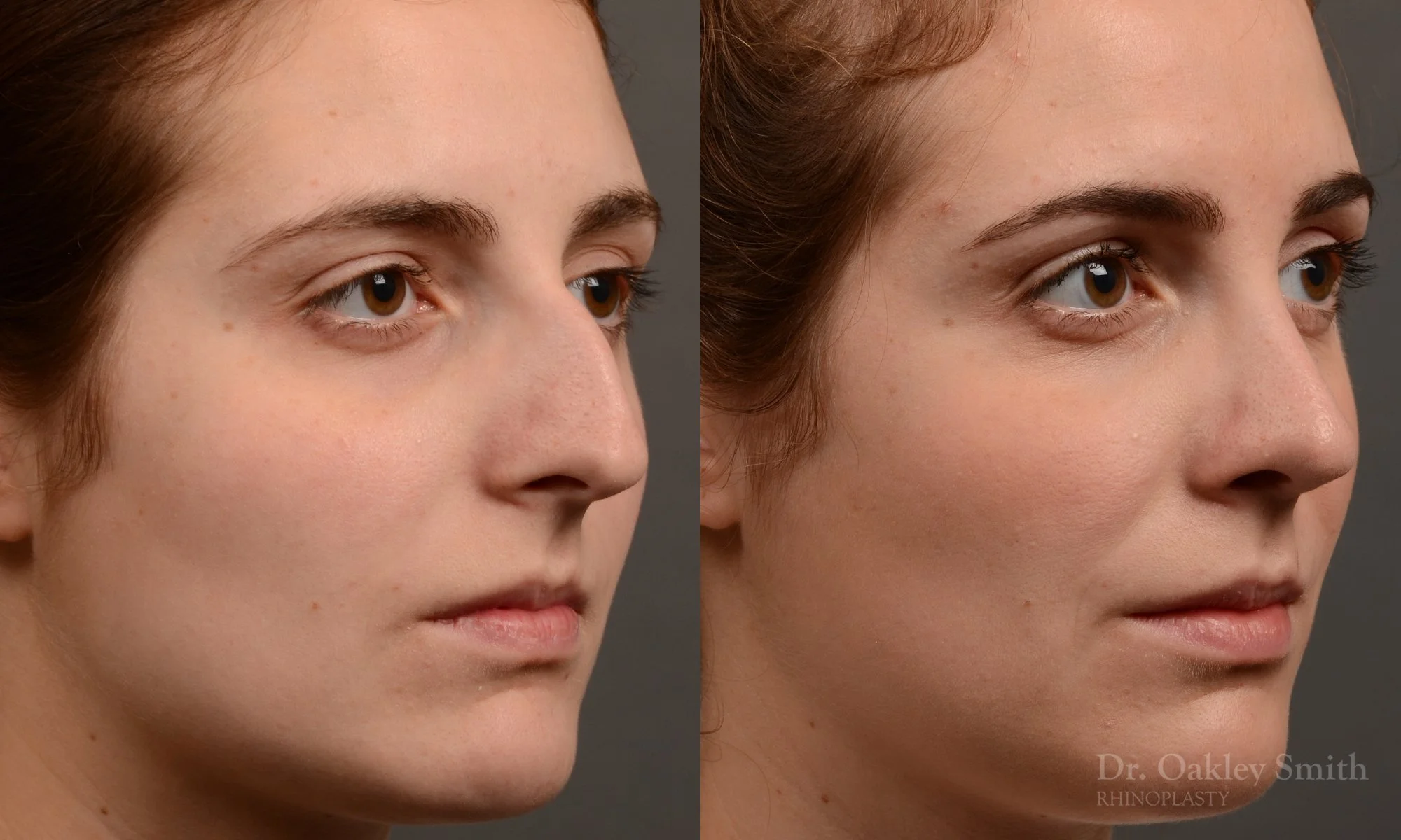 305.1B-rhinoplasty-dr-oakley-smith-toronto-nose-job.jpg