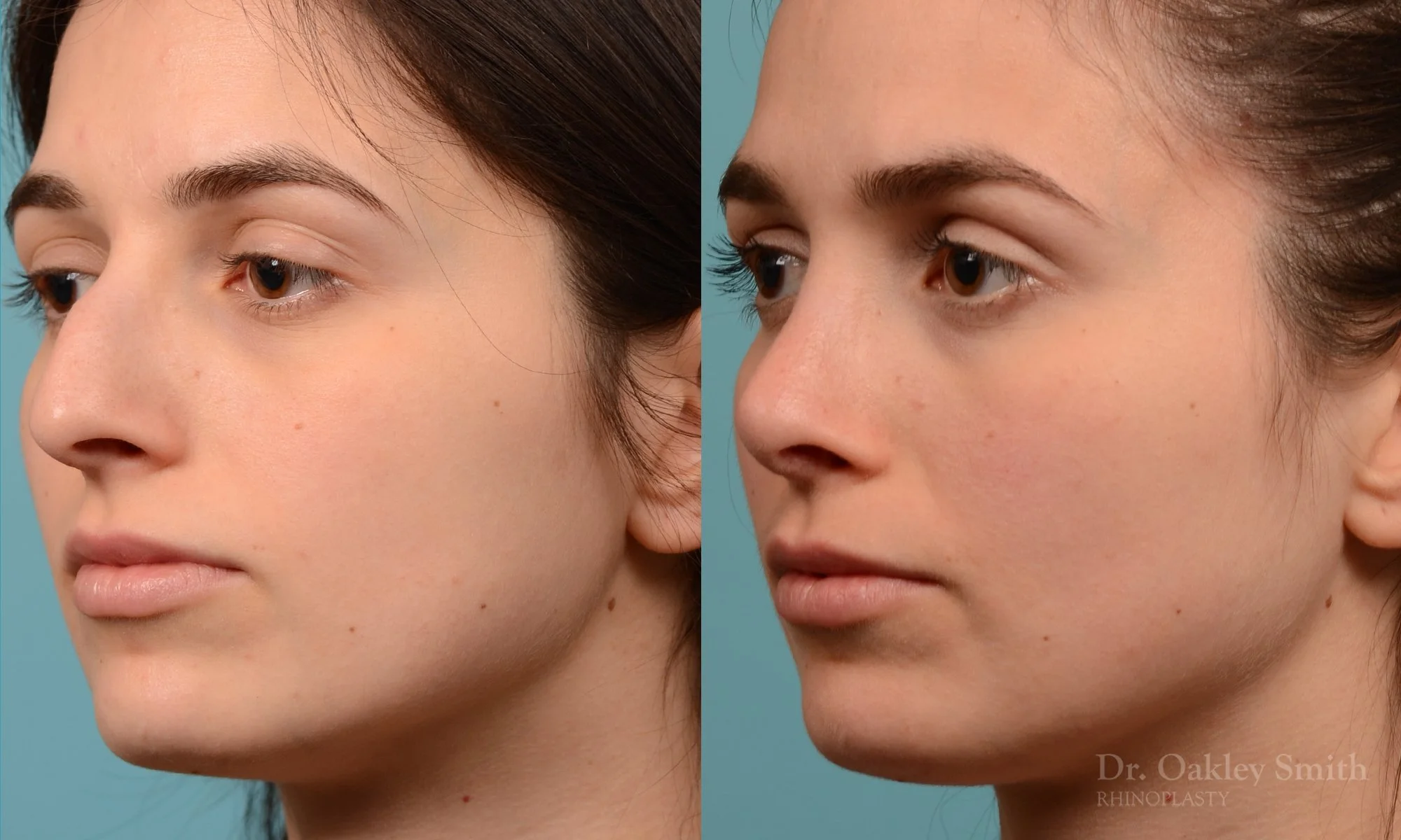 289D-rhinoplasty-dr-oakley-smith-toronto-nose-job.jpg