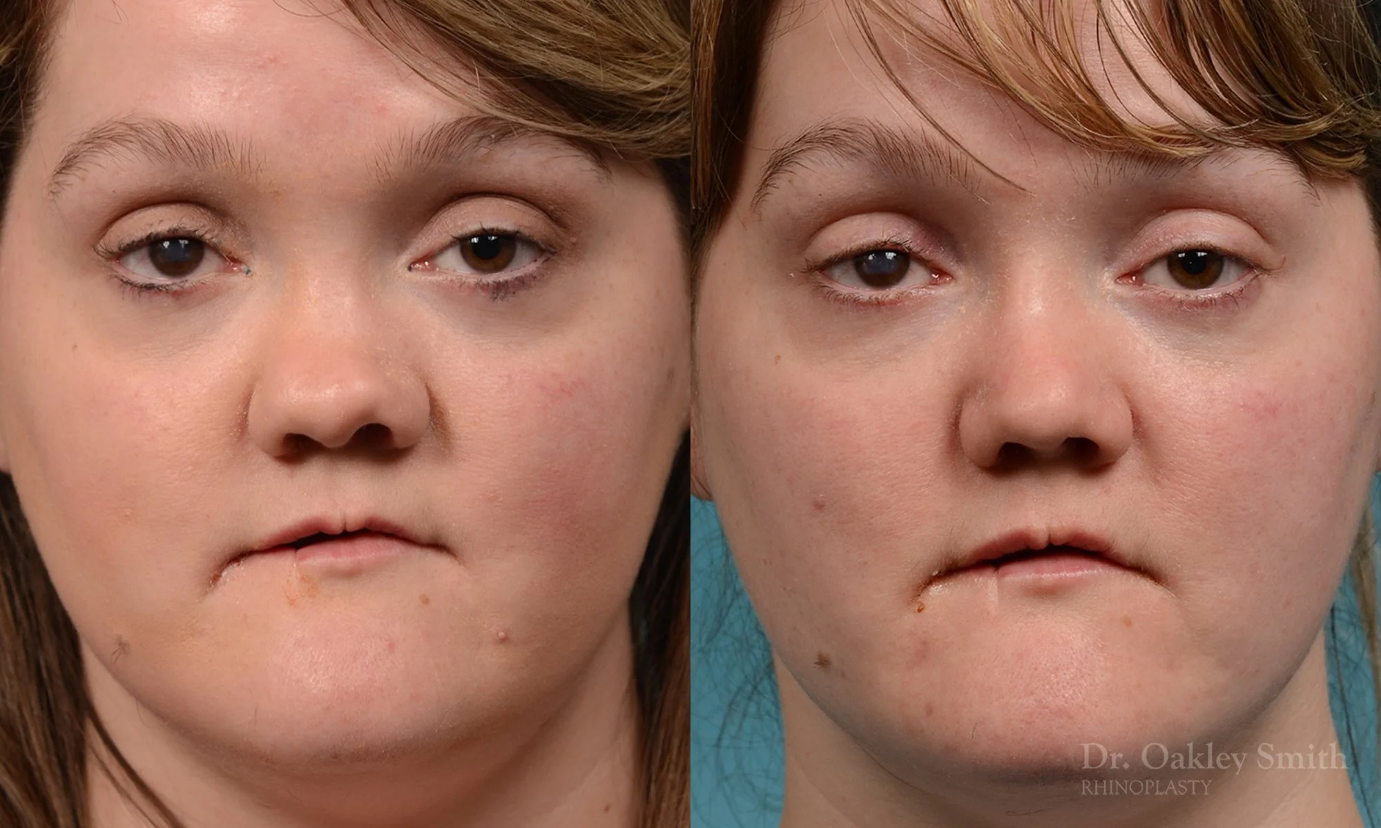 241A-rhinioplasty-nose-job-dr-oakley-smith-toronto-1.jpg