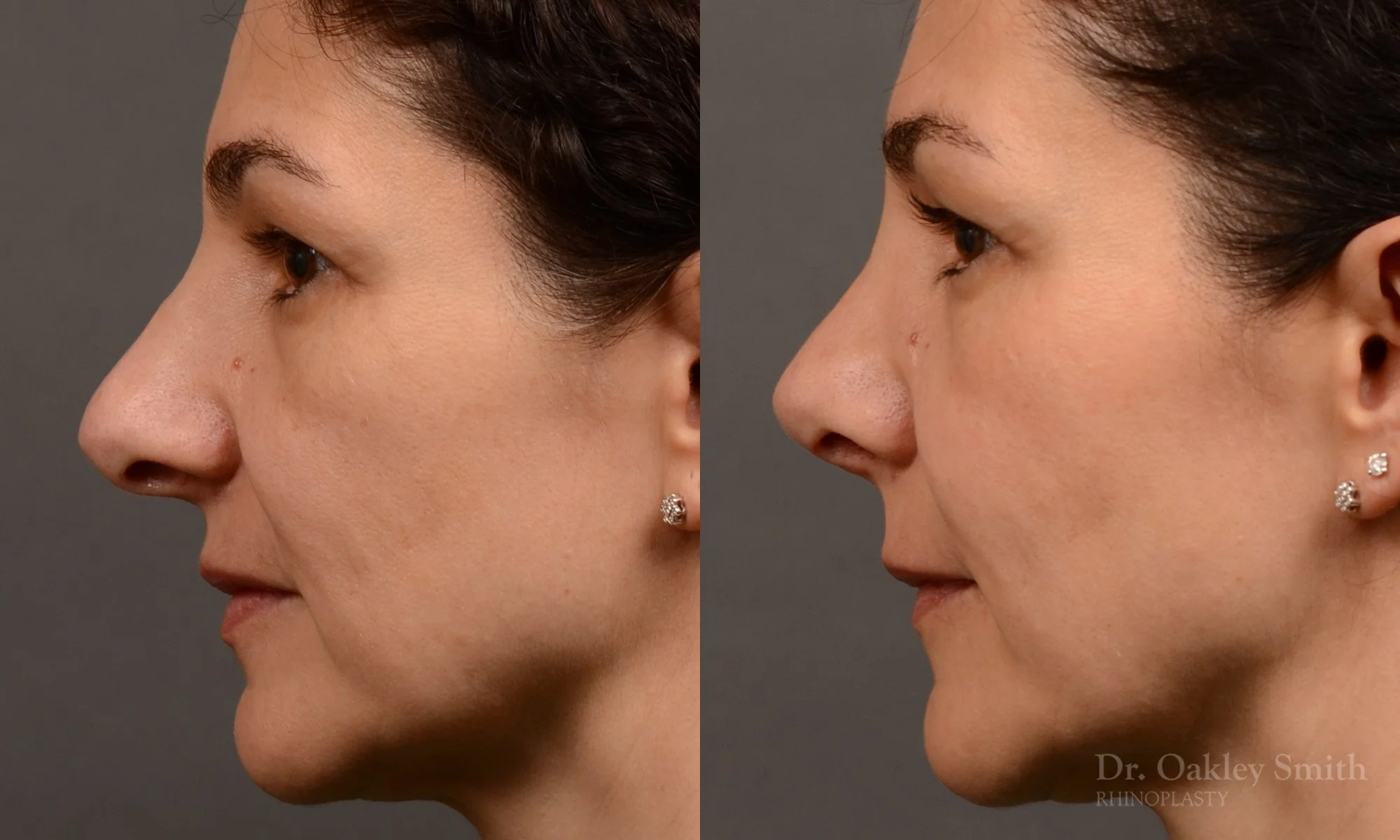 512E-rhinoplasty-dr-oakley-smith-toronto-top-surgeon-nose-job.jpg