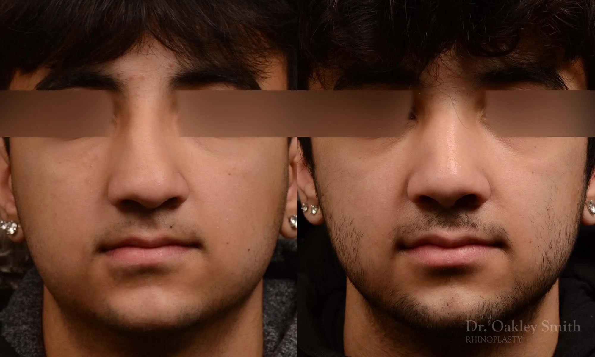 520A-male-rhinoplasty-dr-oakley-smith-toronto-top-surgeon-nose-job.jpg
