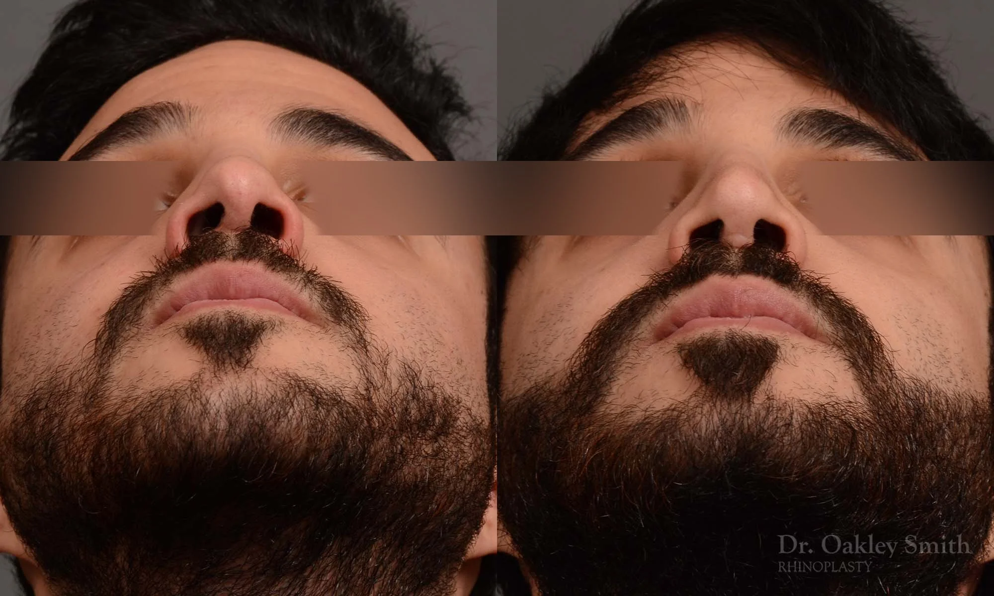 327.1F-rhinoplasty-dr-oakley-smith-toronto-nose-job.jpg