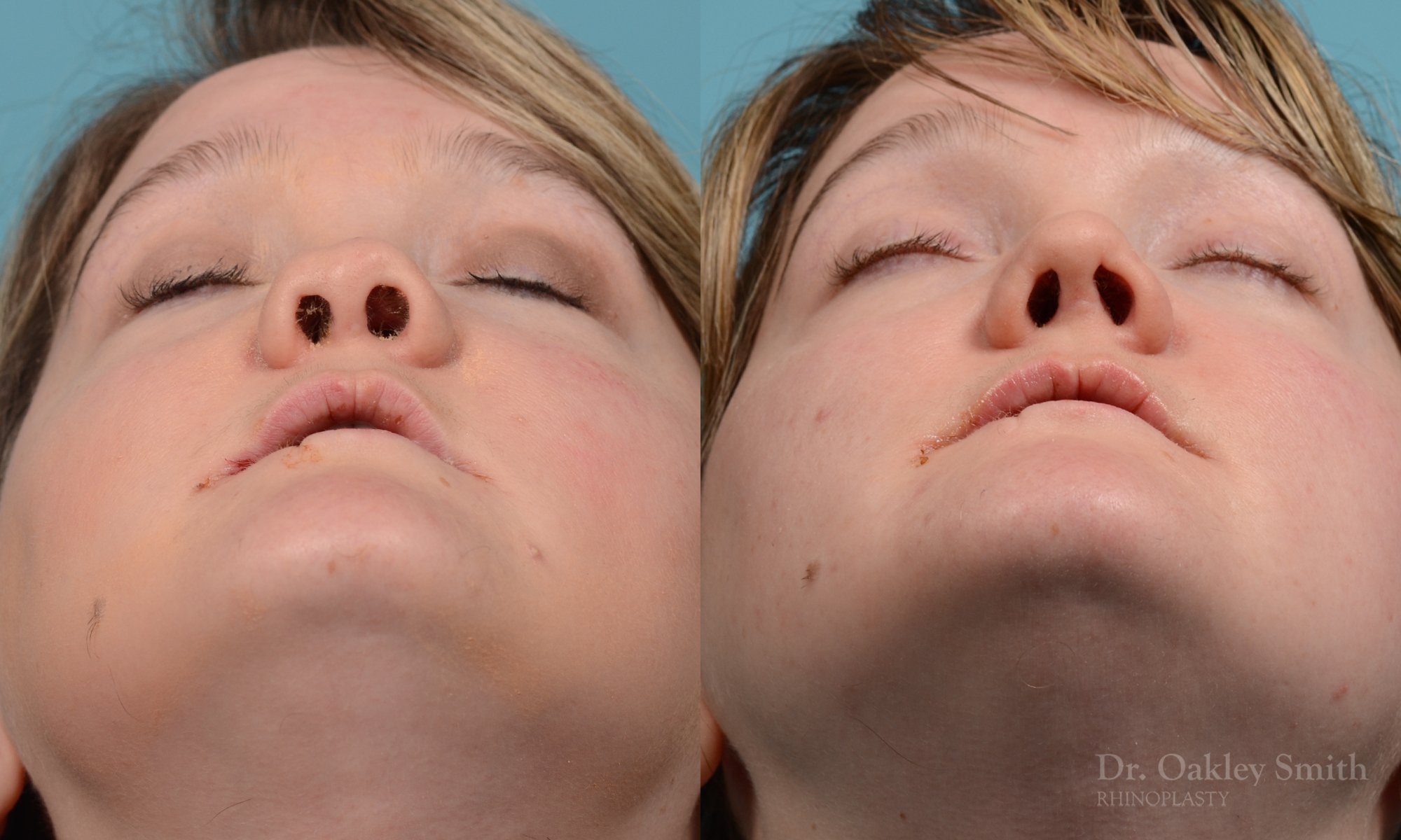241F-rhinioplasty-nose-job-dr-oakley-smith-toronto-1 (1).jpg