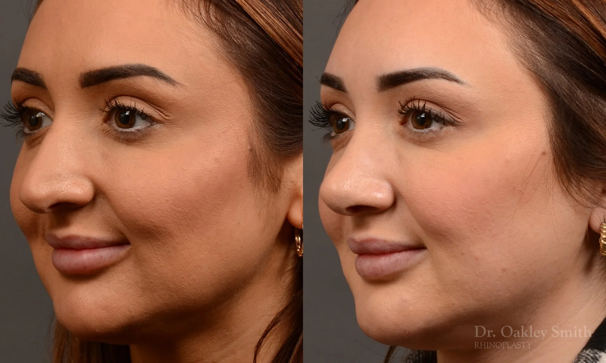 502D-rhinoplasty-dr-oakley-smith-toronto-top-surgeon-nose-job.jpg