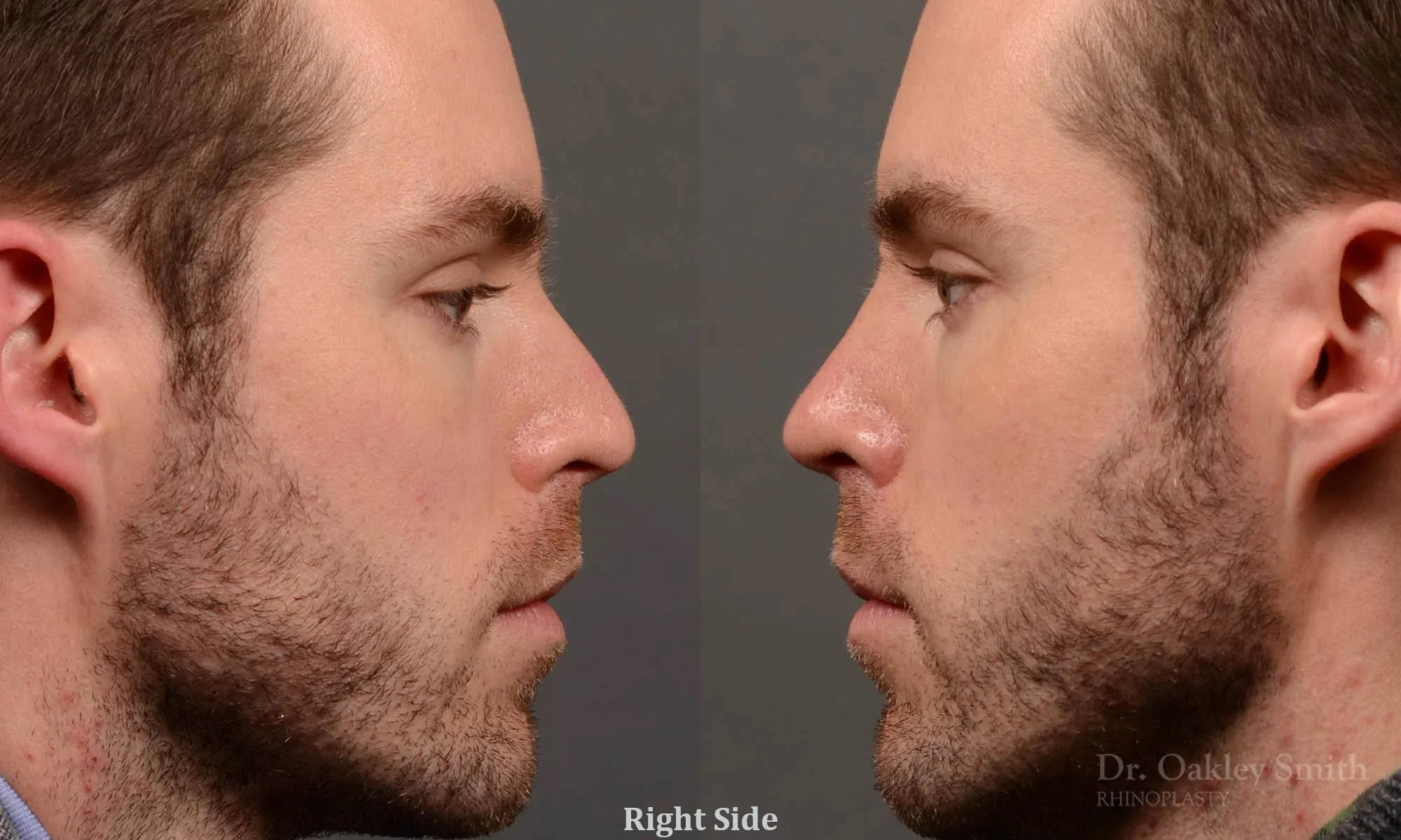 337: Primary Male Rhinoplasty, Normal Skin,  Tip Refinement