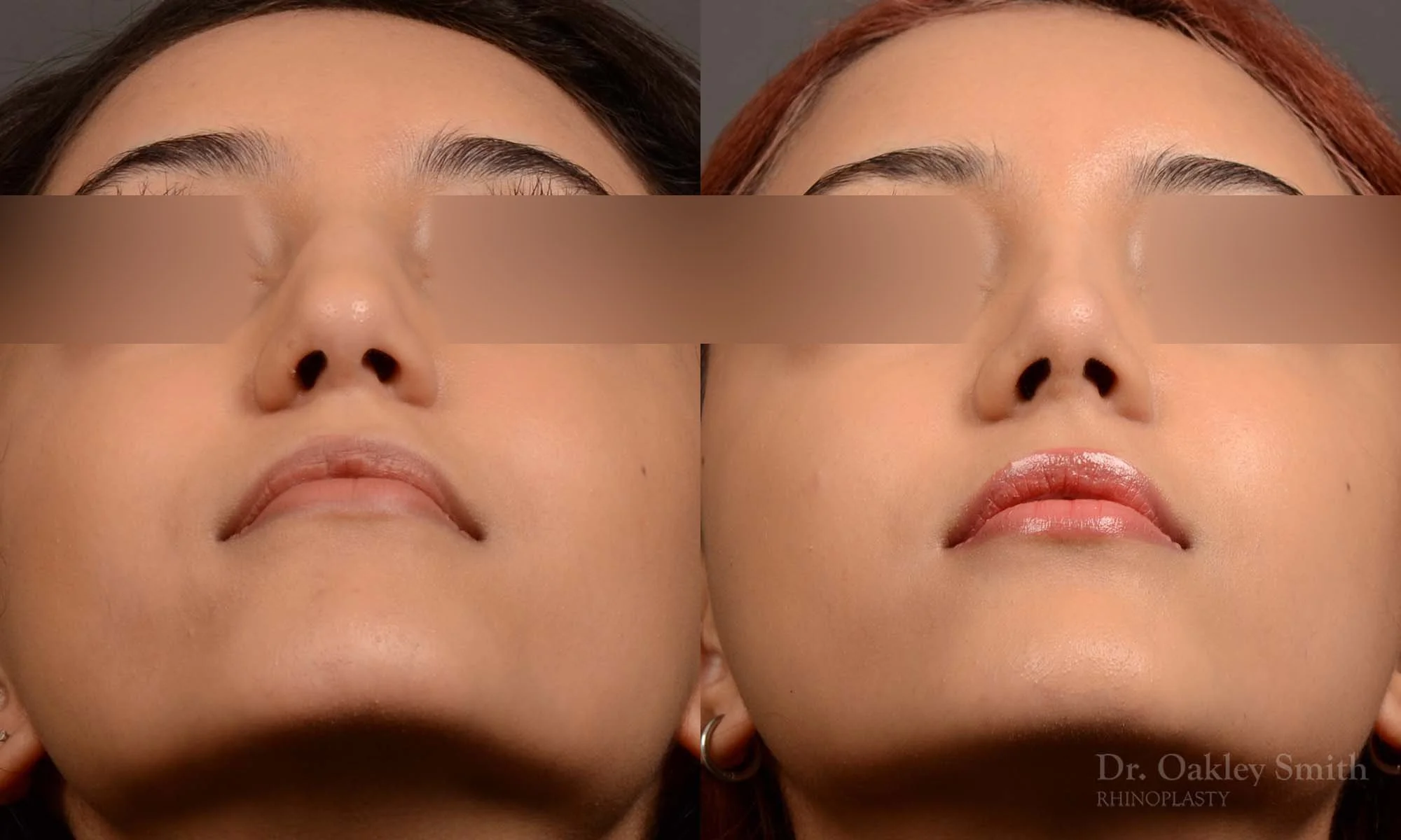 533F-rhinoplasty-dr-oakley-smith-toronto-top-surgeon-nose-job.jpg