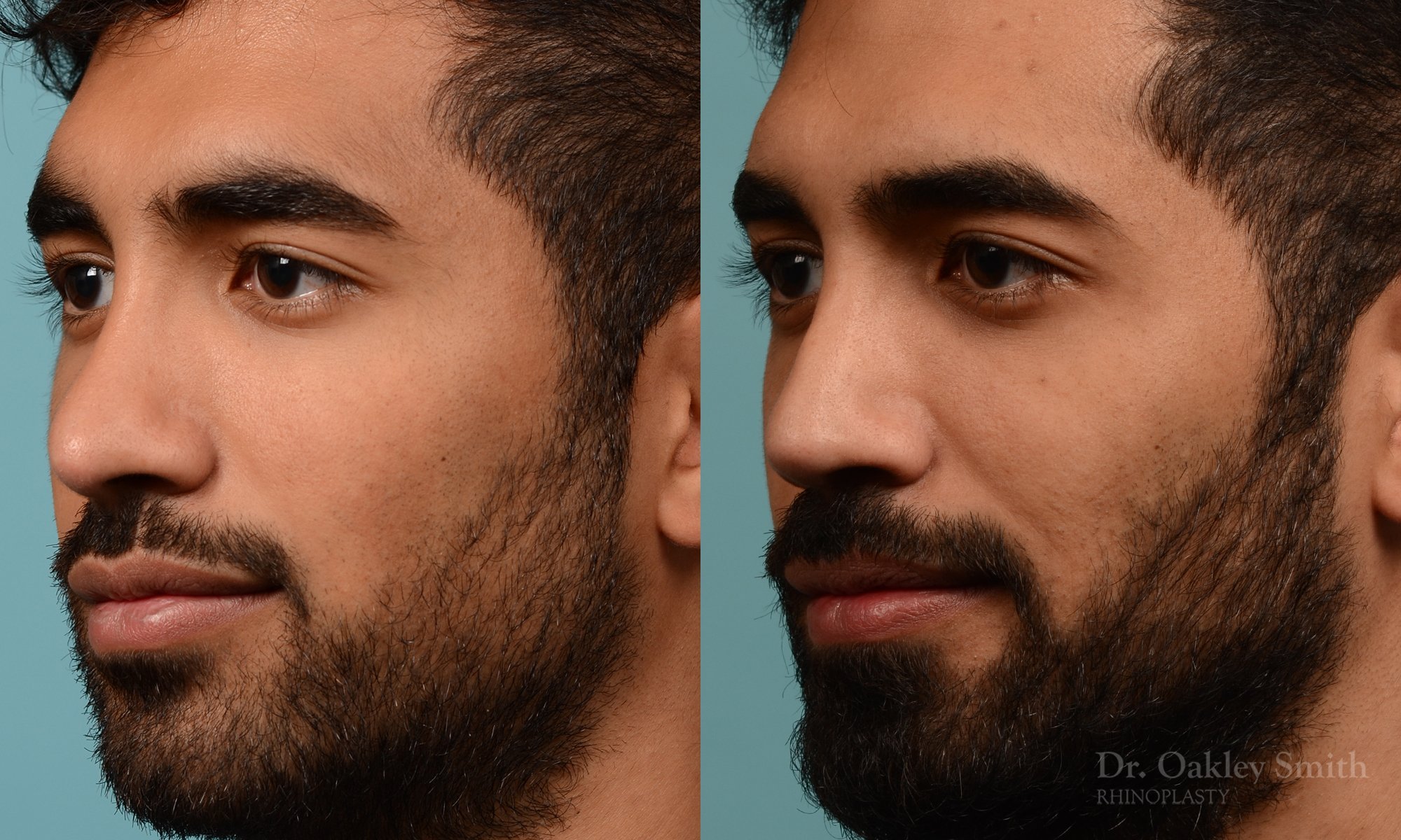 201.1D-rhinoplasty-dr-oakley-smith-toronto-nose-job.jpg