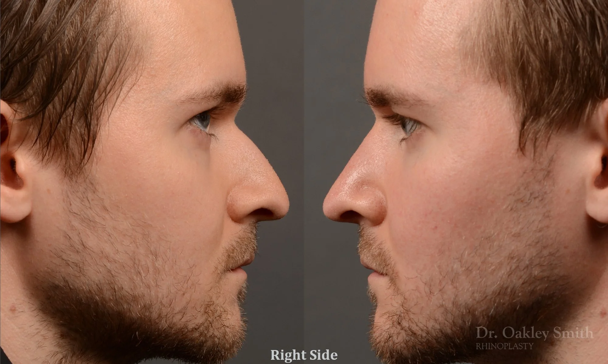 401C-expert-rhinoplasty-surgeon-rhinoplasty-dr-oakley-smith-toronto-nose-job-surgery.jpg
