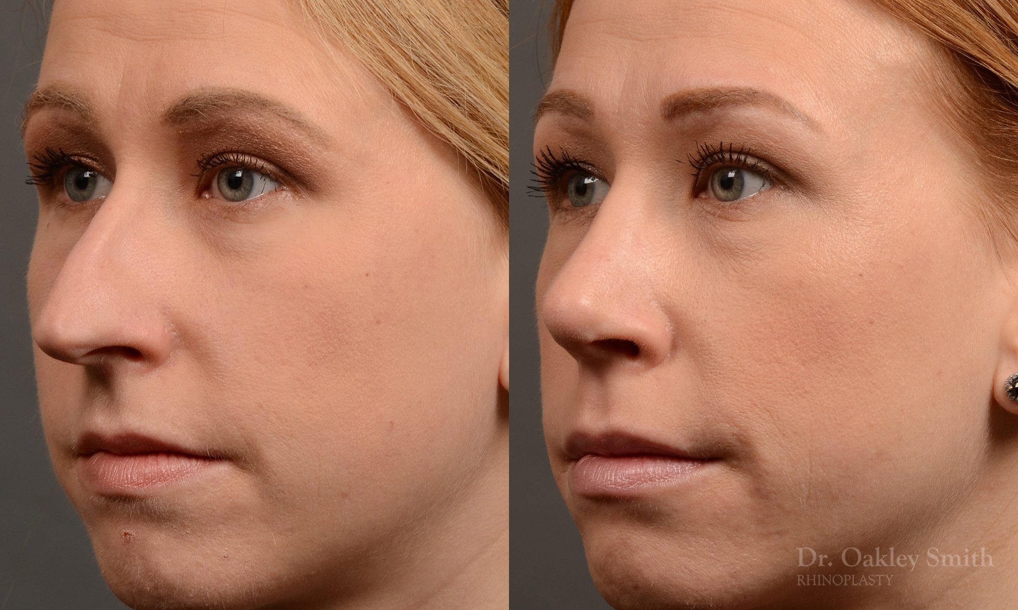 363.2D-rhinoplasty-dr-oakley-smith-toronto-nose-job.jpg